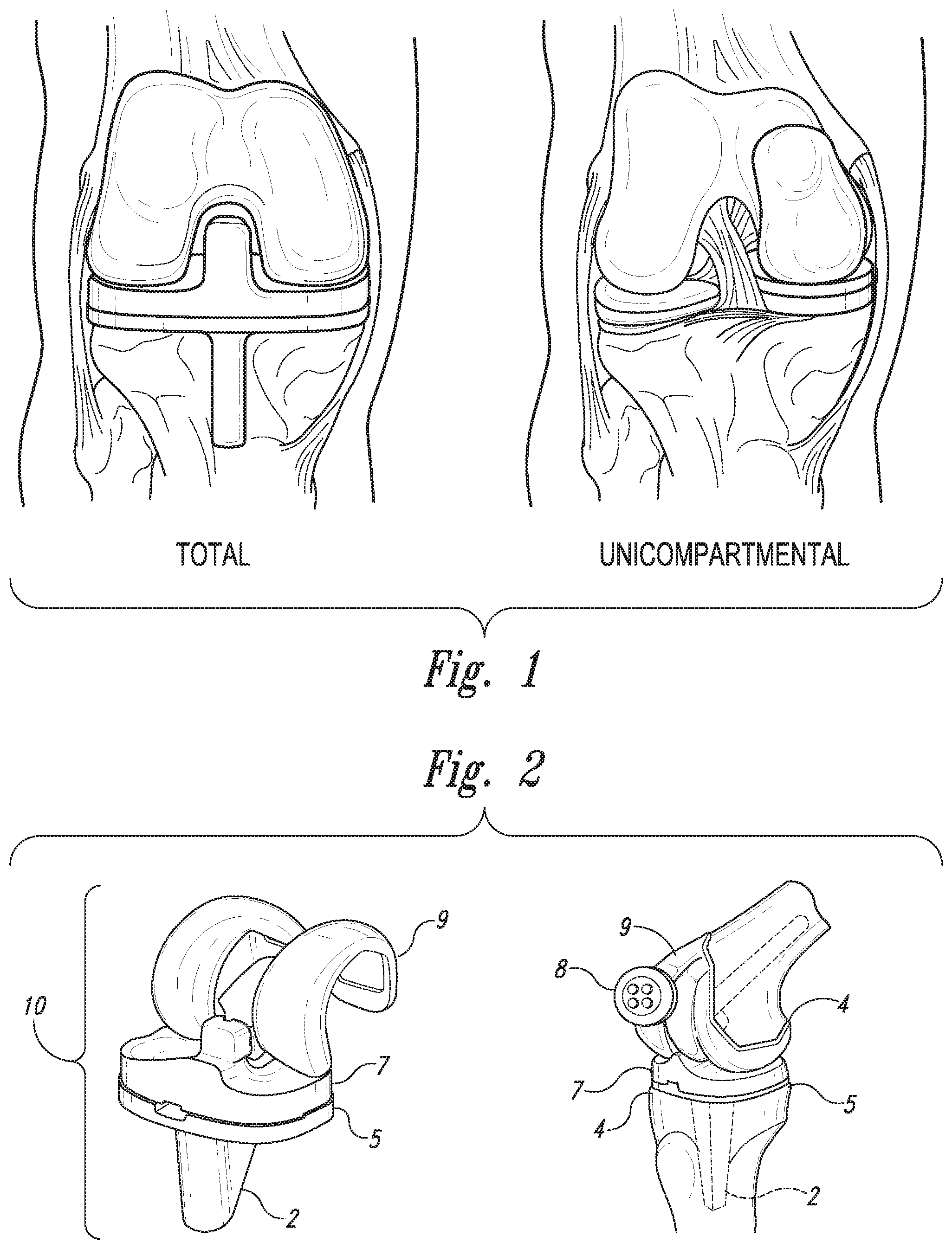 Patent US12097044 Figure 1 – Devices, systems and methods for monitoring knee replacements