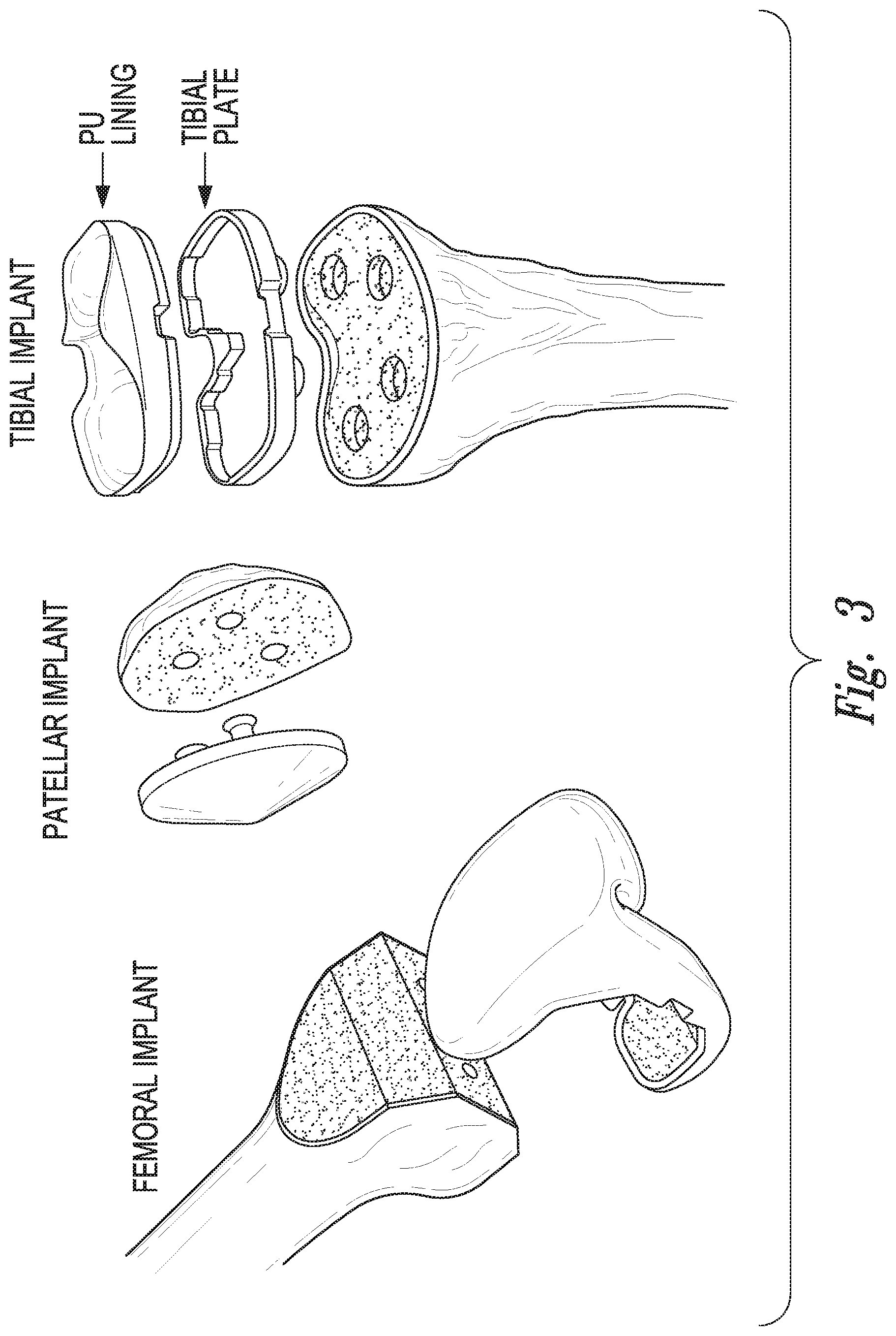Patent US12097044 Figure 2 – Devices, systems and methods for monitoring knee replacements