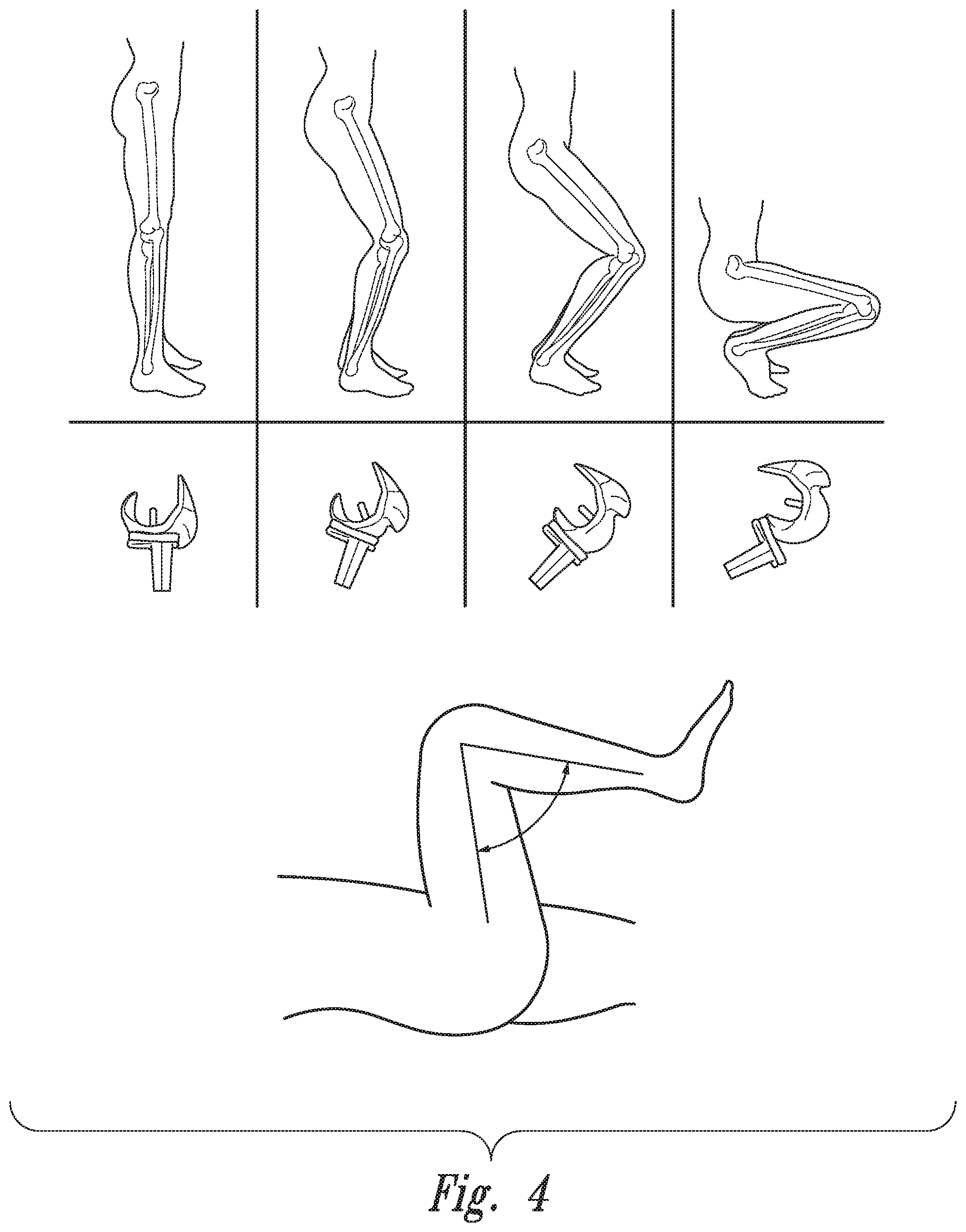 Patent US12097044 Figure 3 – Devices, systems and methods for monitoring knee replacements