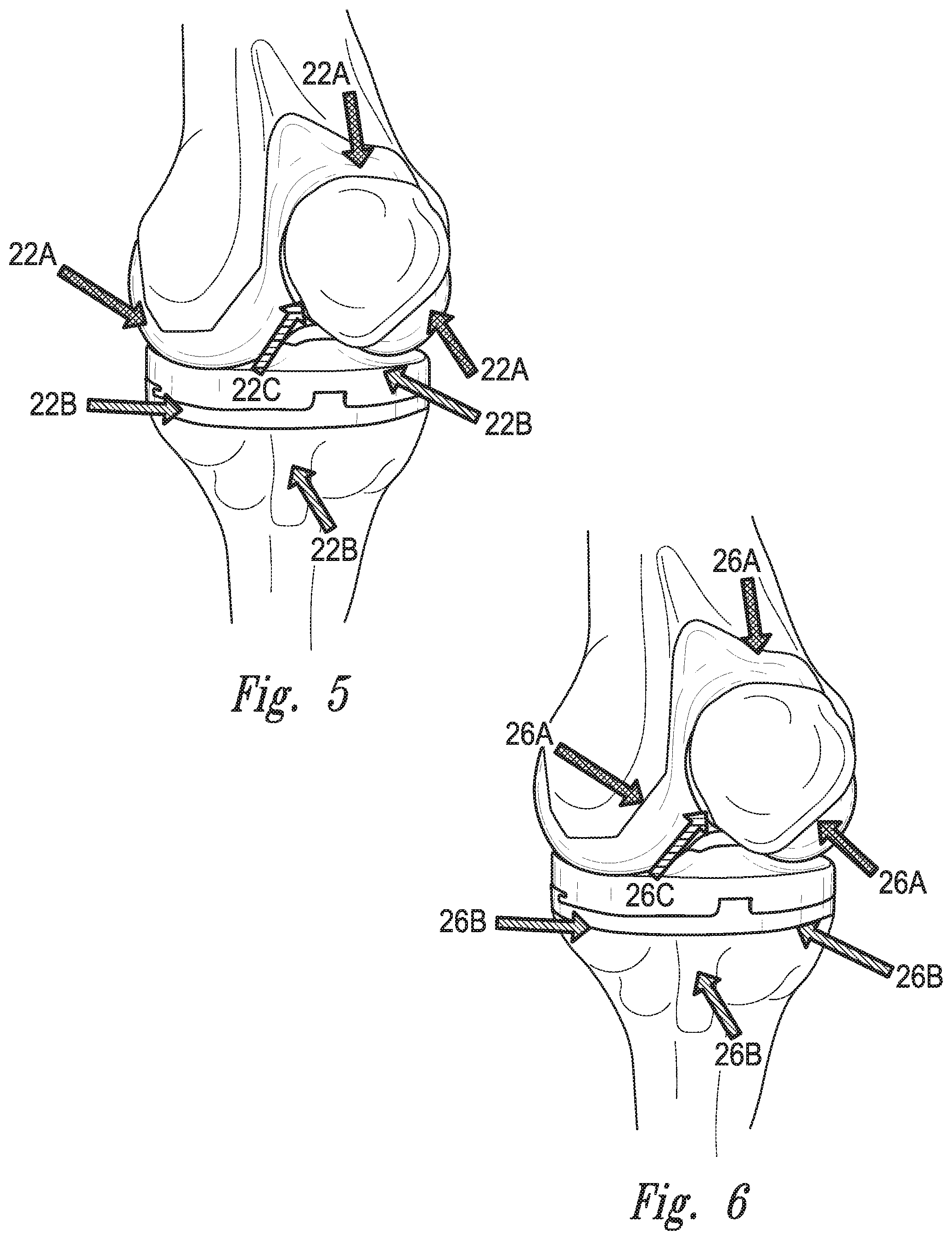Patent US12097044 Figure 4 – Devices, systems and methods for monitoring knee replacements