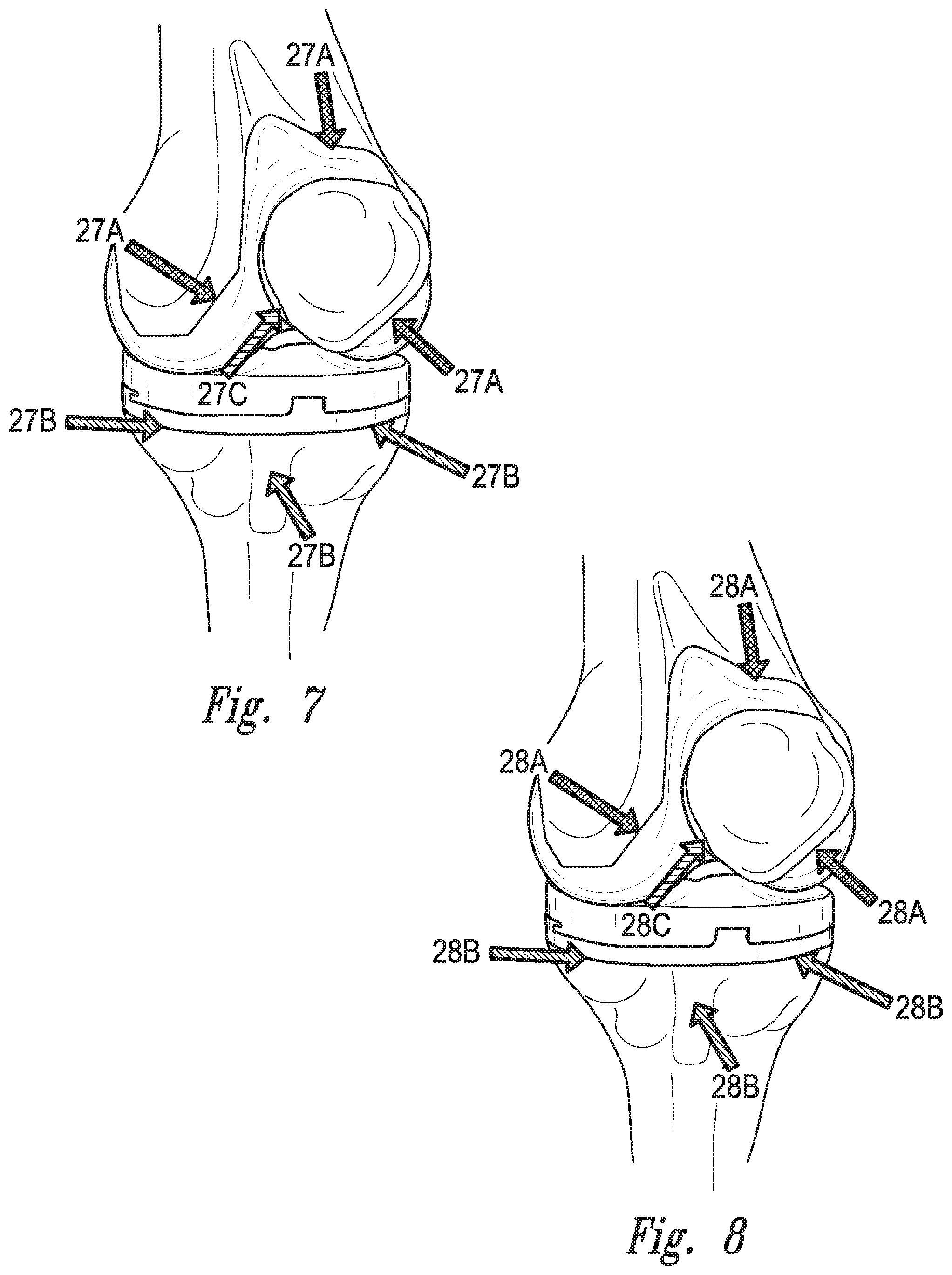 Patent US12097044 Figure 5 – Devices, systems and methods for monitoring knee replacements