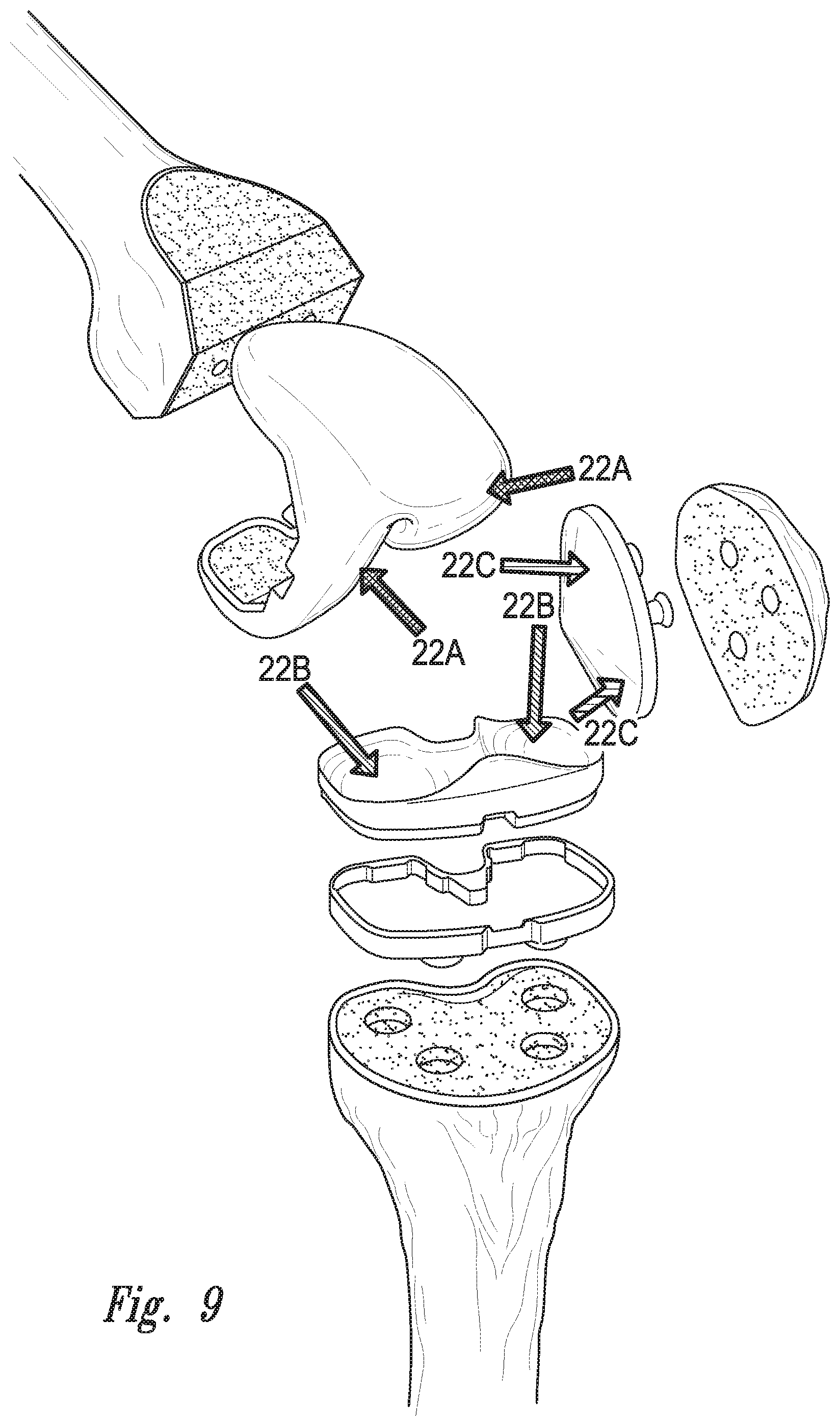 Patent US12097044 Figure 6 – Devices, systems and methods for monitoring knee replacements