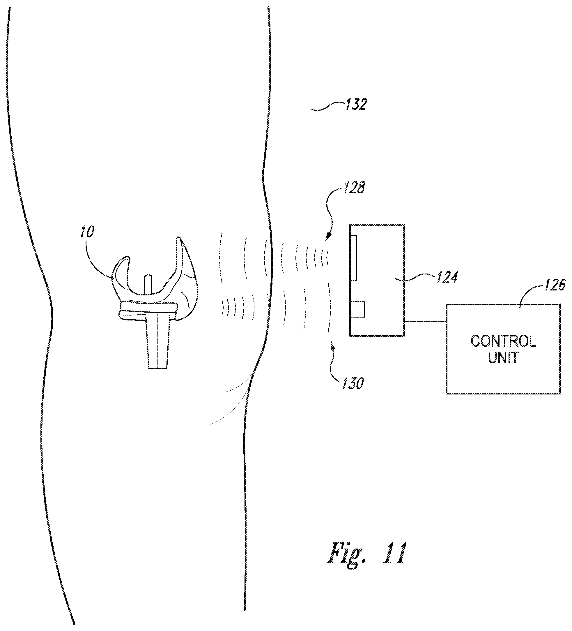 Patent US12097044 Figure 8 – Devices, systems and methods for monitoring knee replacements