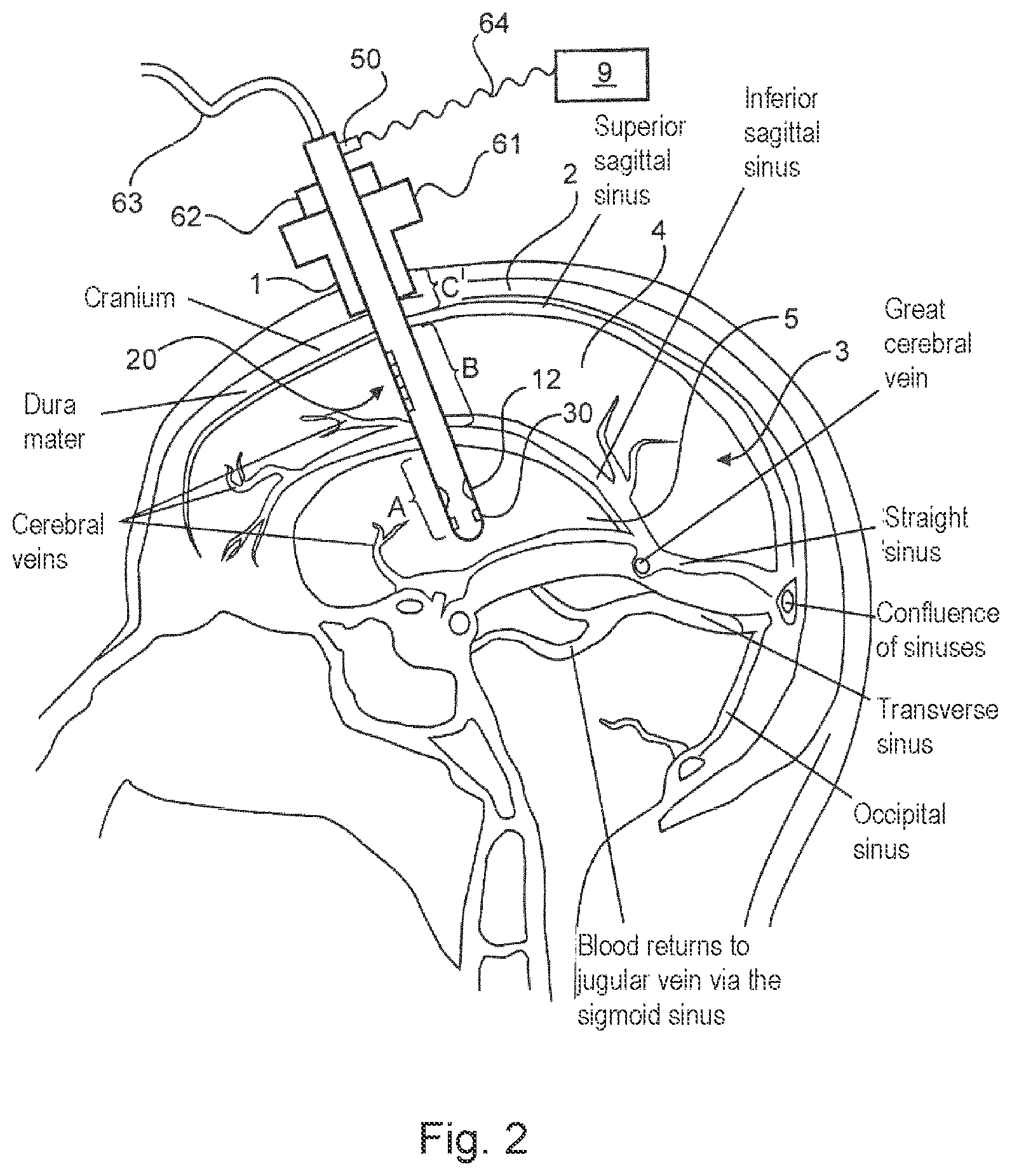 Patent US12097047 Figure 2 – Device for drainage of the brain
