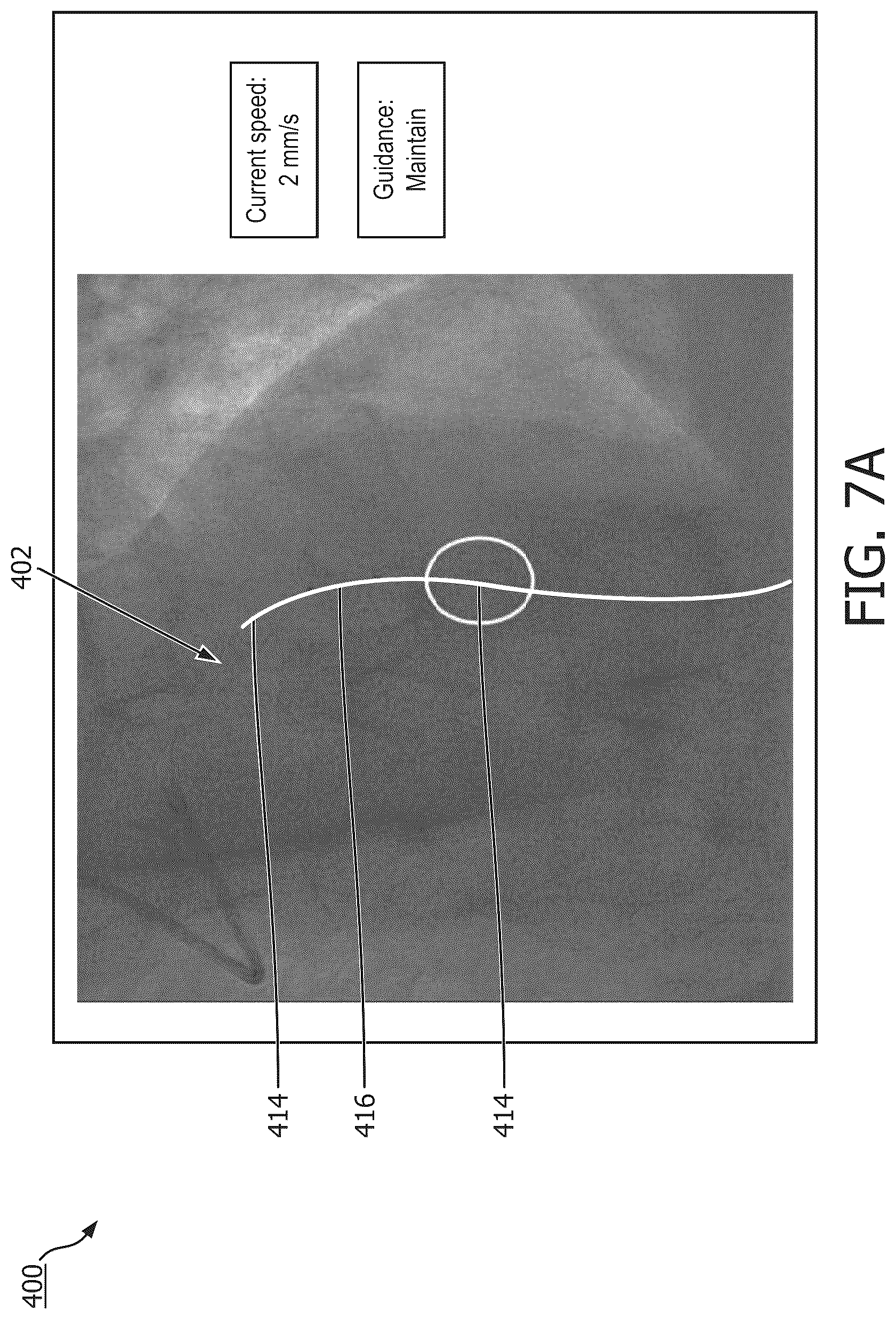 Patent US12097058 Figure 7 – Intravascular device movement speed guidance and associated devices, systems, and methods