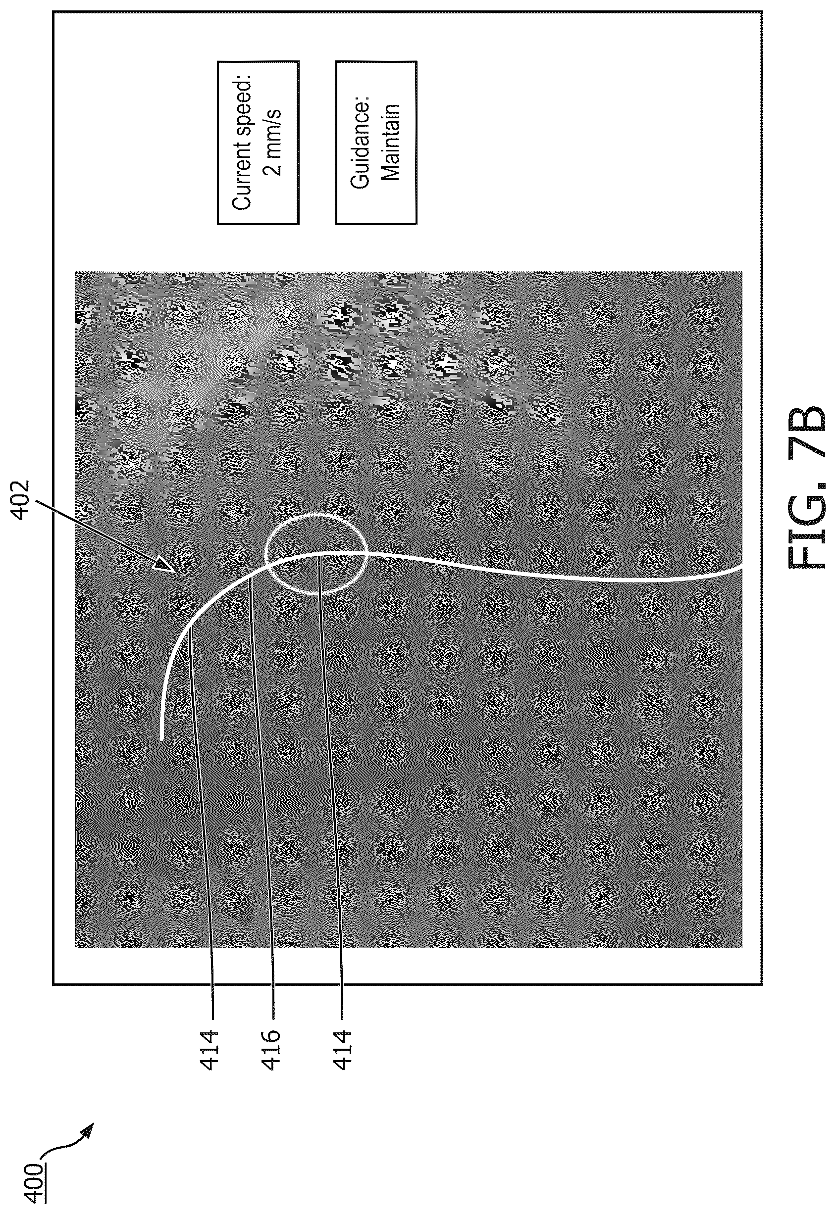 Patent US12097058 Figure 8 – Intravascular device movement speed guidance and associated devices, systems, and methods