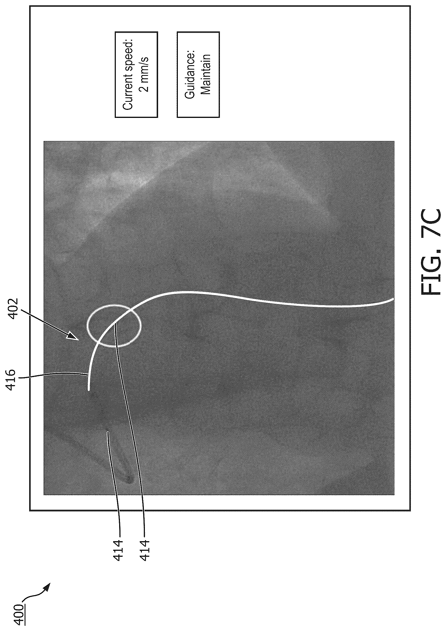 Patent US12097058 Figure 9 – Intravascular device movement speed guidance and associated devices, systems, and methods