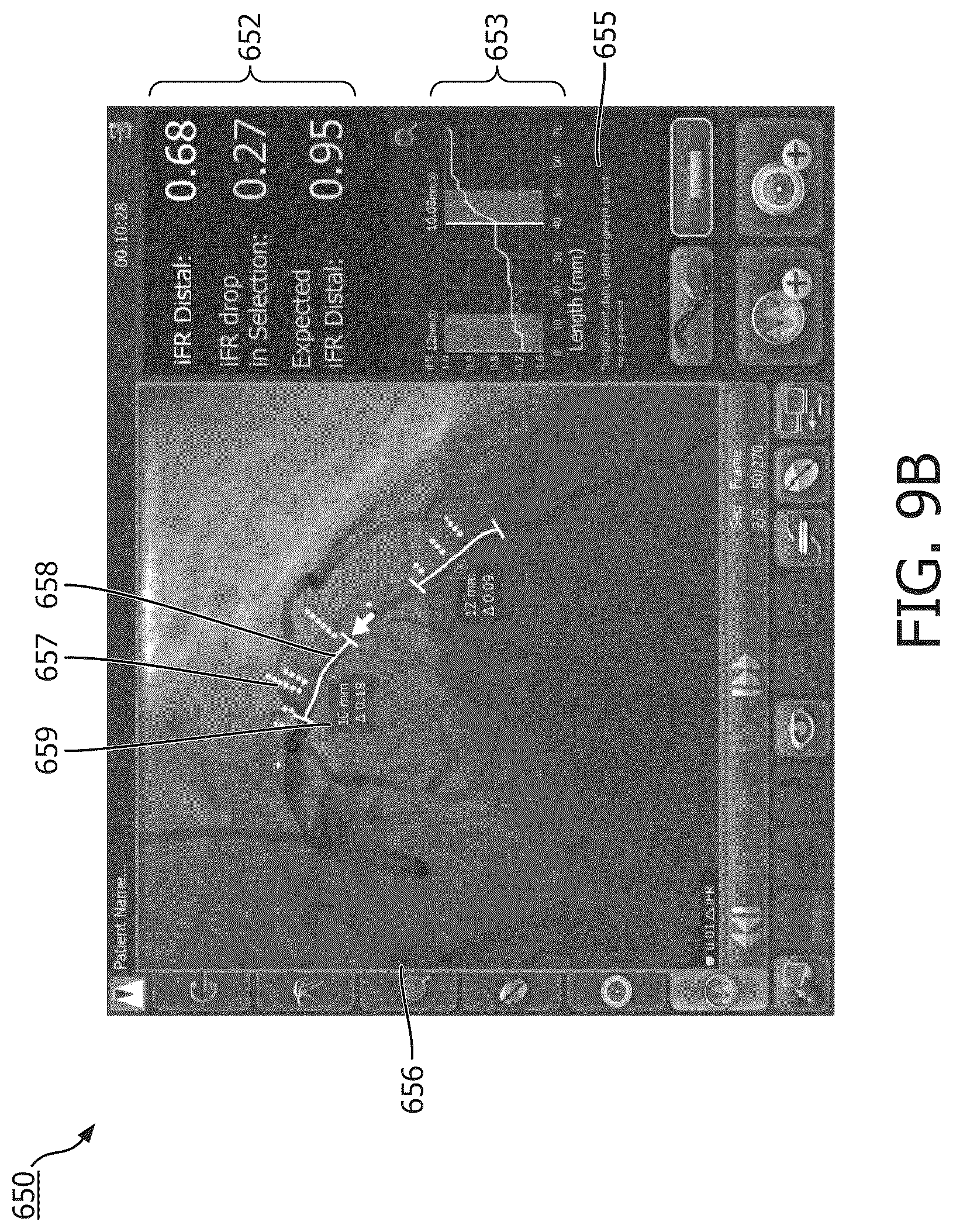Patent US12097058 Figure 12 – Intravascular device movement speed guidance and associated devices, systems, and methods
