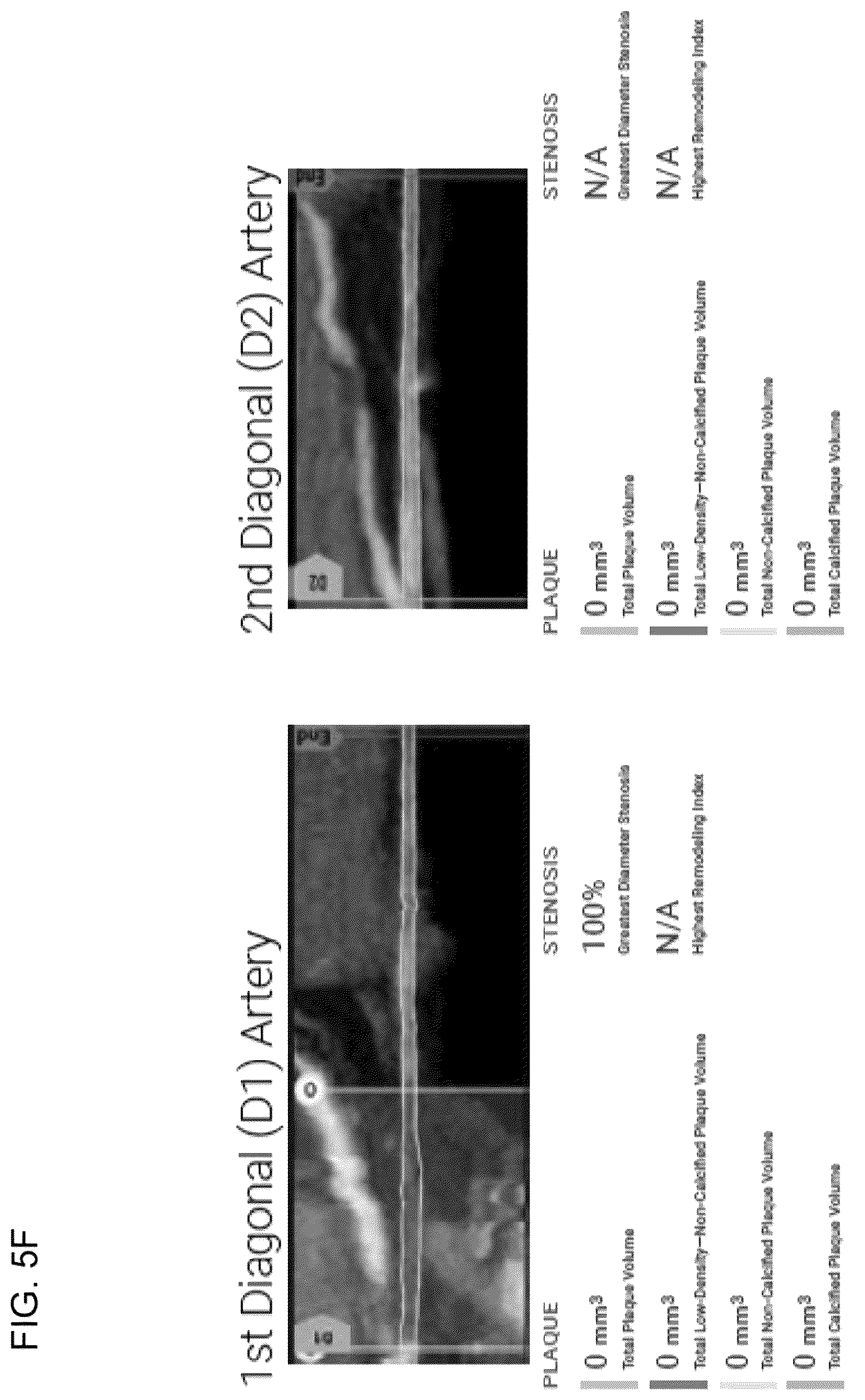 Patent US12097063 Figure 16 – Systems, methods, and devices for medical image analysis, diagnosis, risk stratification, decision making and/or disease tracking
