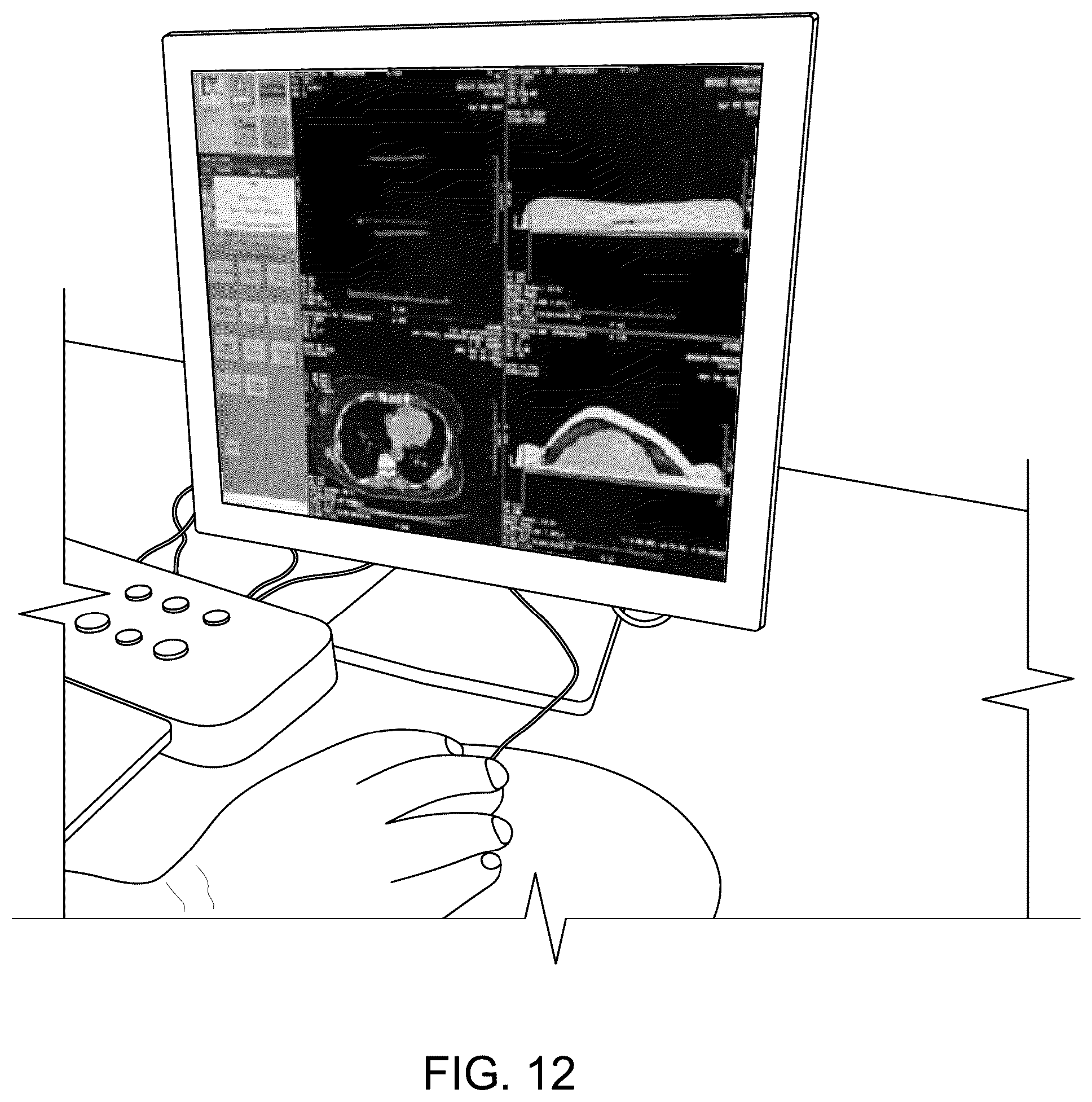 Patent US12097068 Figure 12 – Multisegment breast tissue mimic
