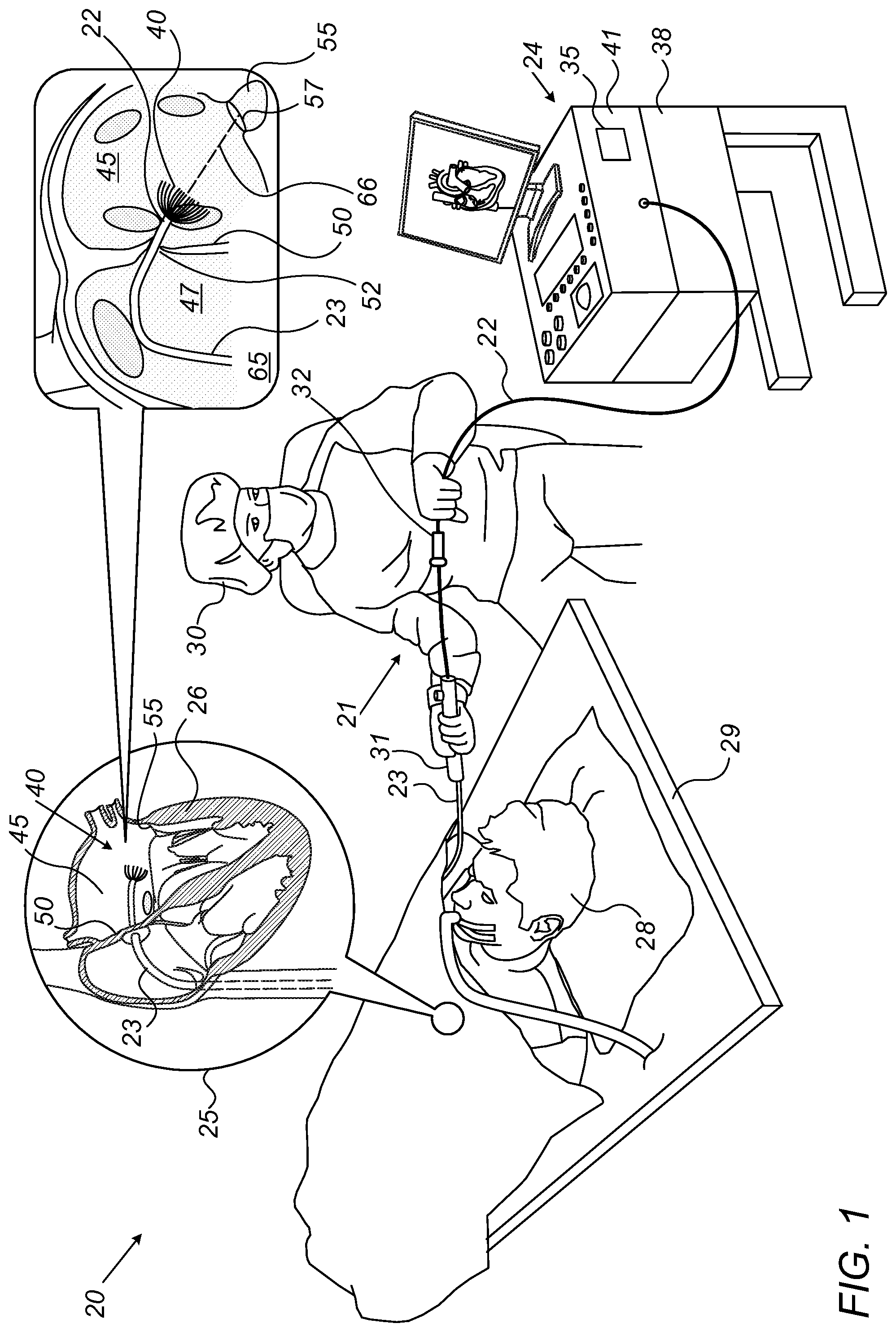 Patent US12097071 Figure 1 – Left atrial appendage (LAA) transseptal access point optimization