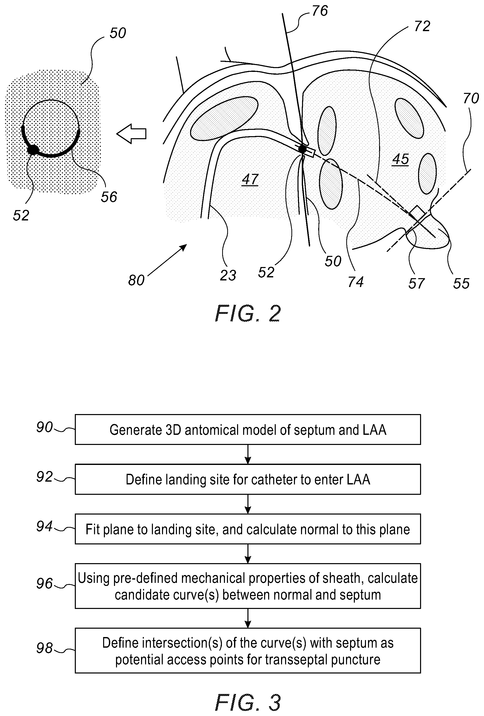 Patent US12097071 Figure 2 – Left atrial appendage (LAA) transseptal access point optimization