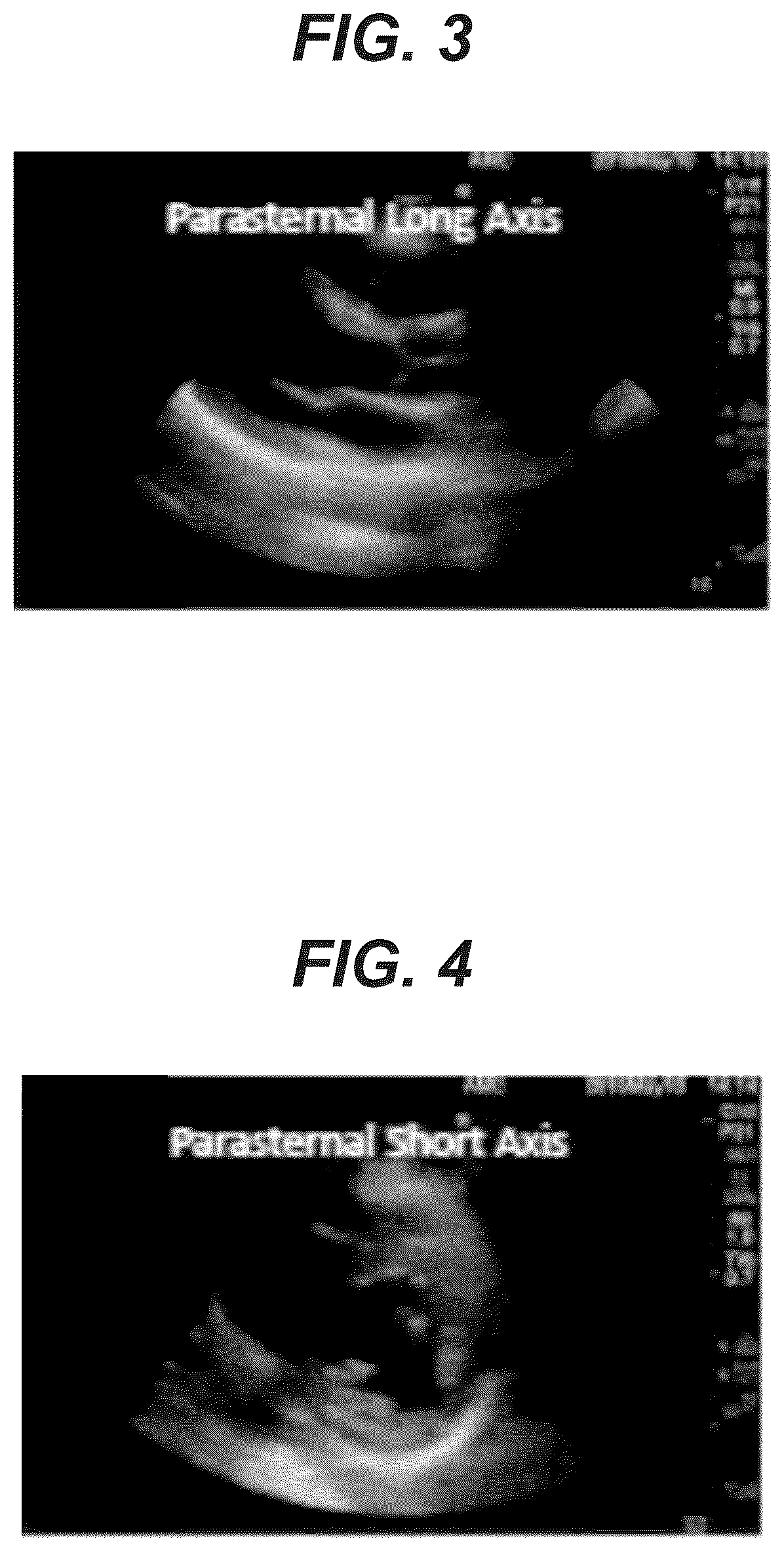 Patent US12097077 Figure 3 – Methods and systems for detecting heart conditions using medical imaging