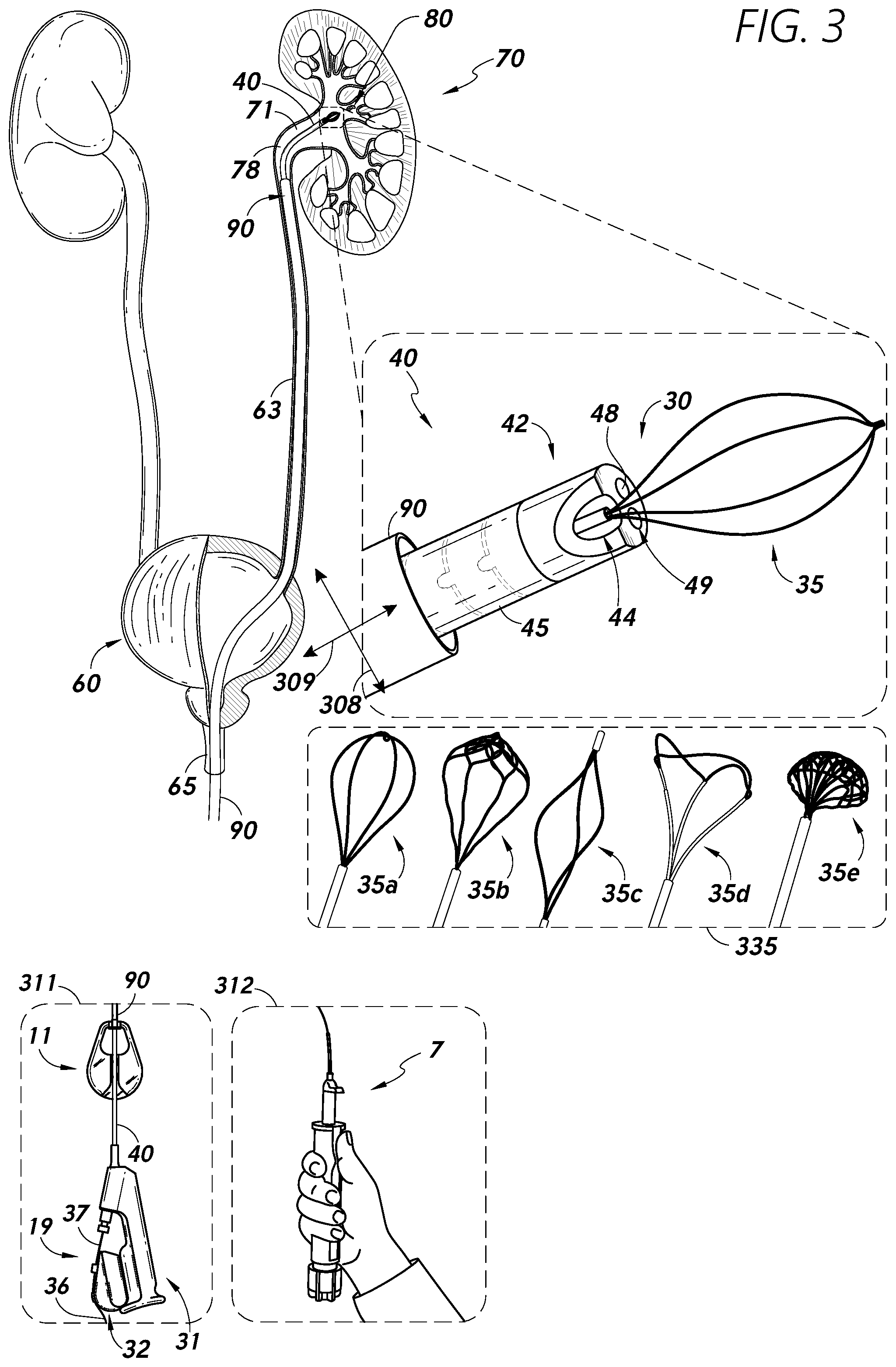 Patent US12097079 Figure 3 – Stuck instrument management
