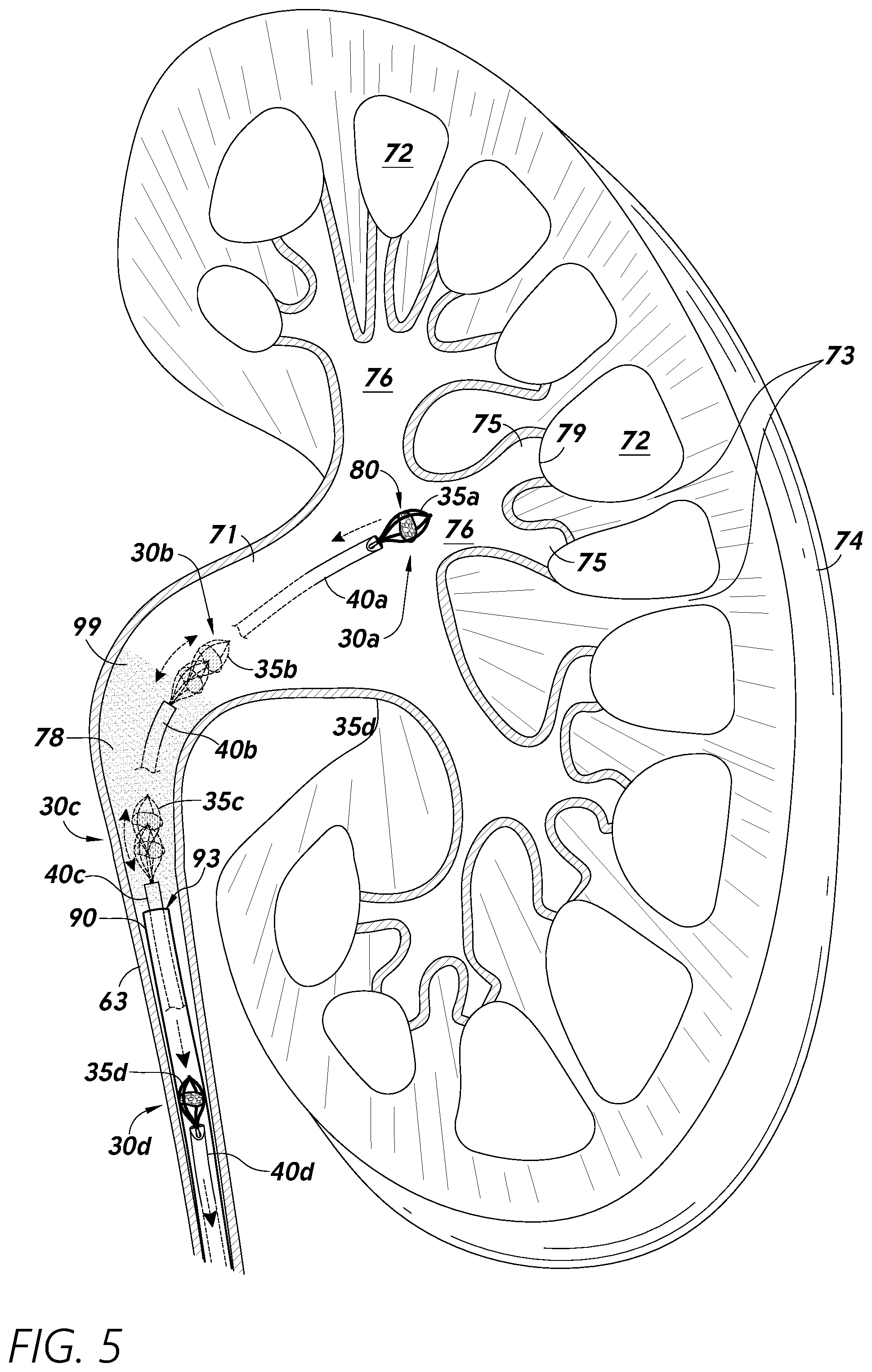 Patent US12097079 Figure 7 – Stuck instrument management