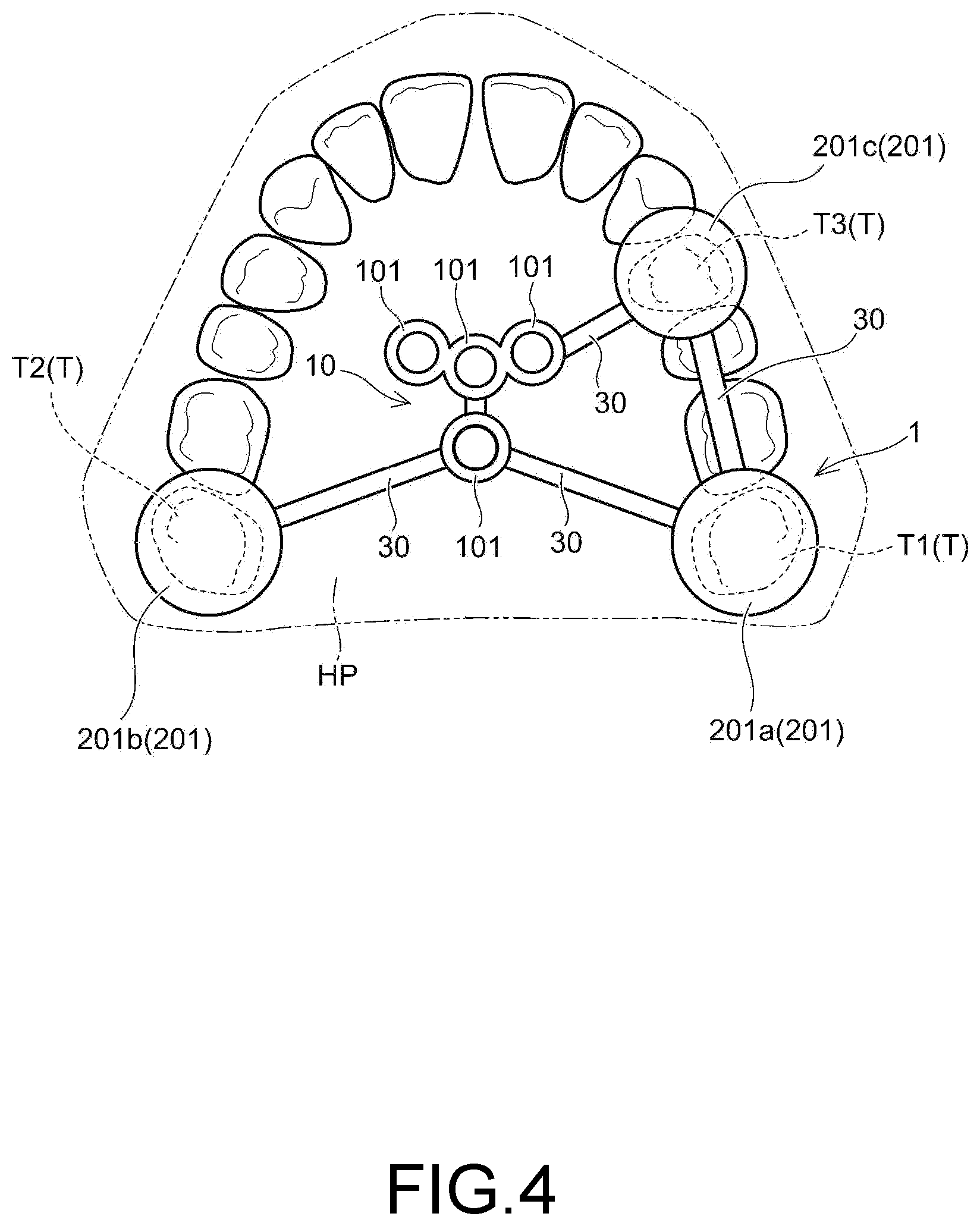 Patent US12097082 Figure 4 – Drill assistance device, screw guide device, and orthodontic tool installation-assisting device set