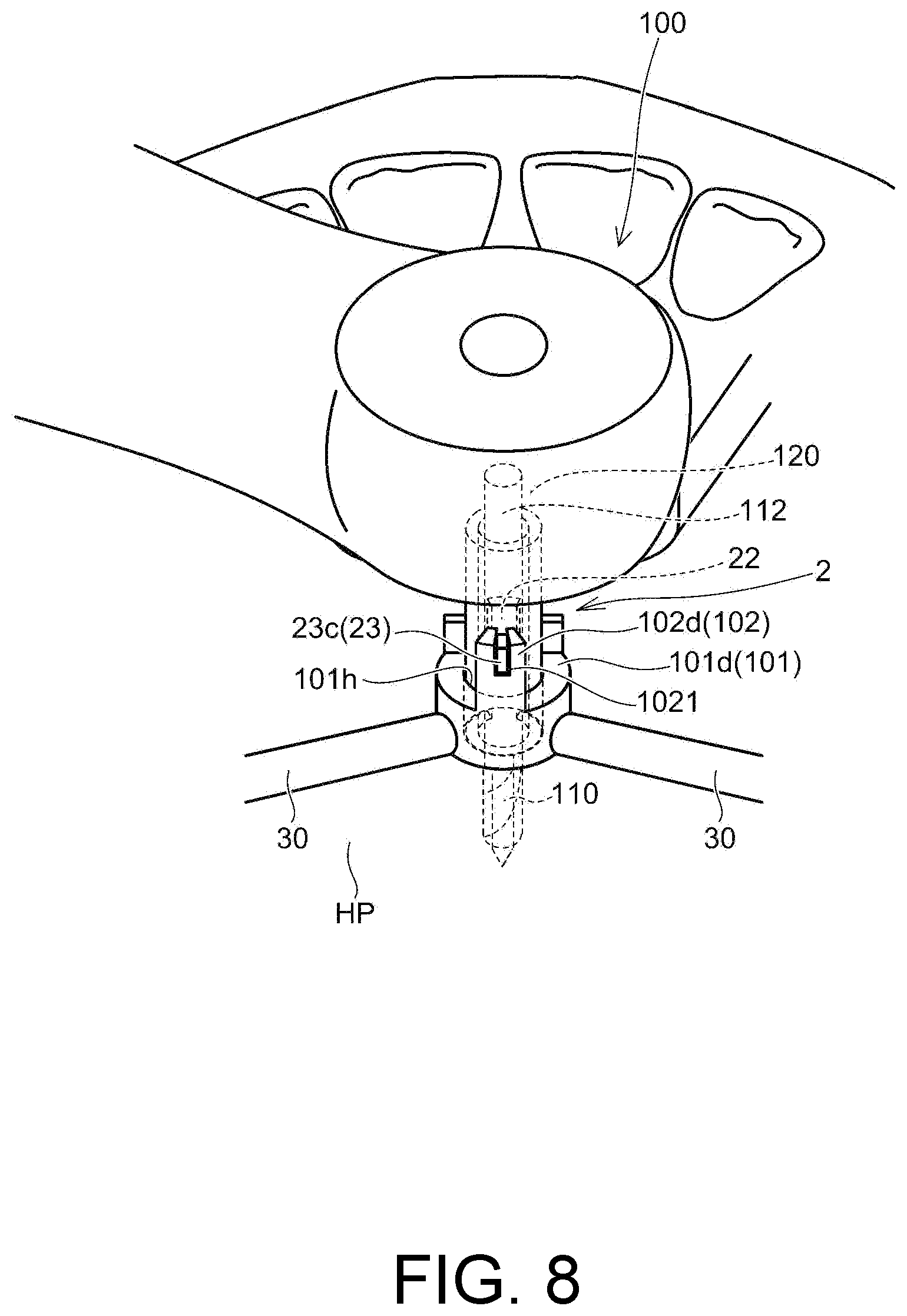 Patent US12097082 Figure 8 – Drill assistance device, screw guide device, and orthodontic tool installation-assisting device set