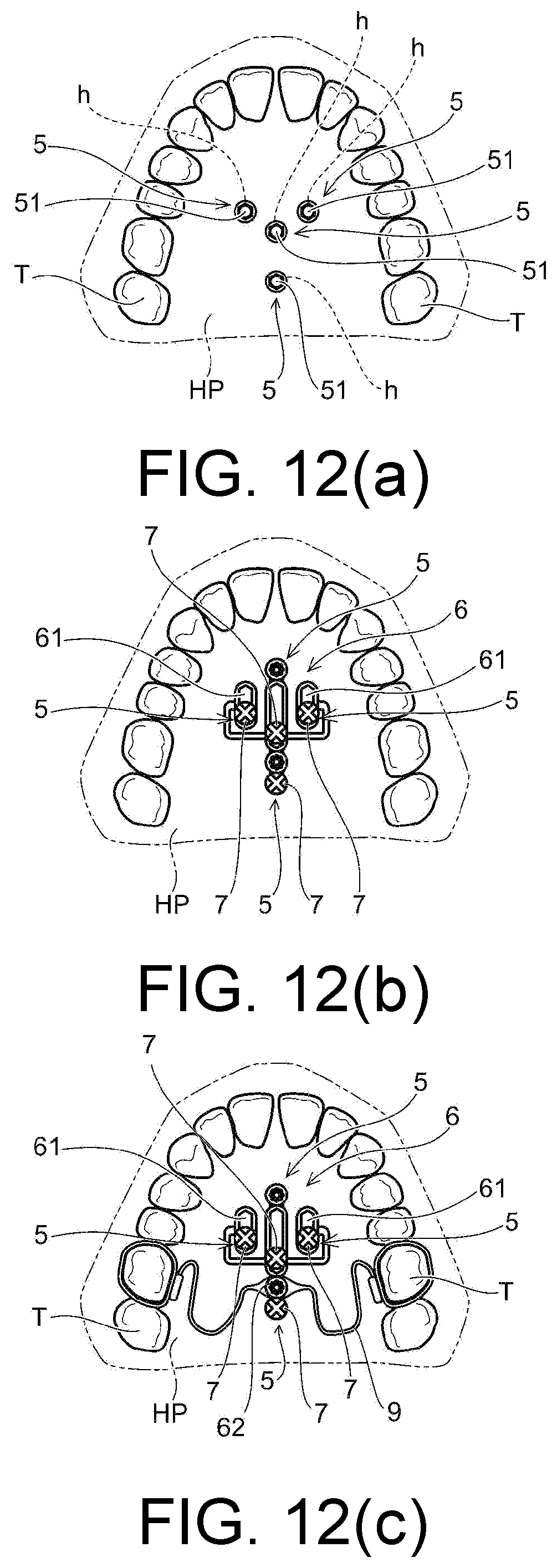 Patent US12097082 Figure 12 – Drill assistance device, screw guide device, and orthodontic tool installation-assisting device set
