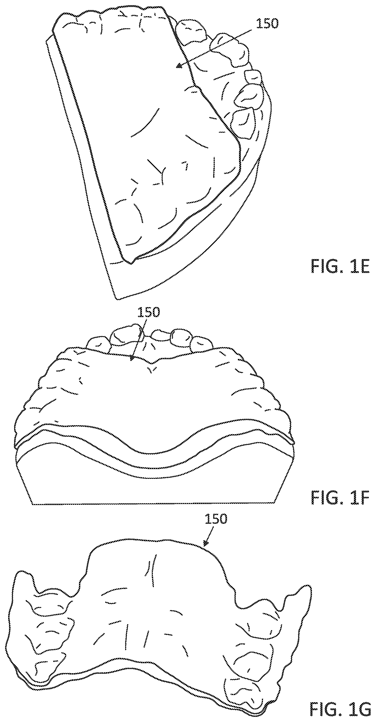 Patent US12097085 Figure 3 – Palatal expanders with breach regions
