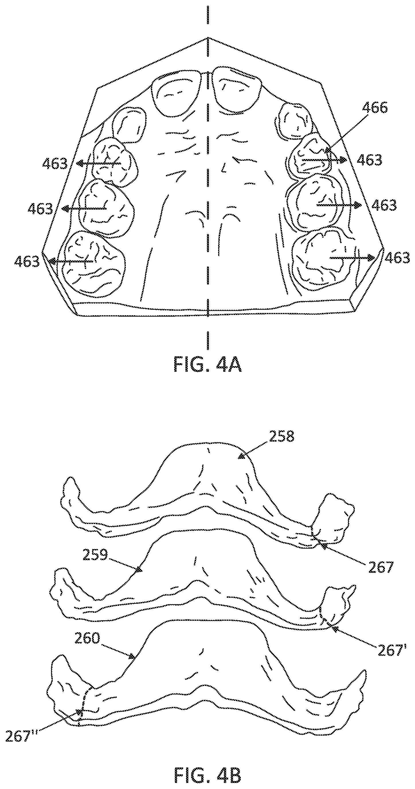 Patent US12097085 Figure 7 – Palatal expanders with breach regions