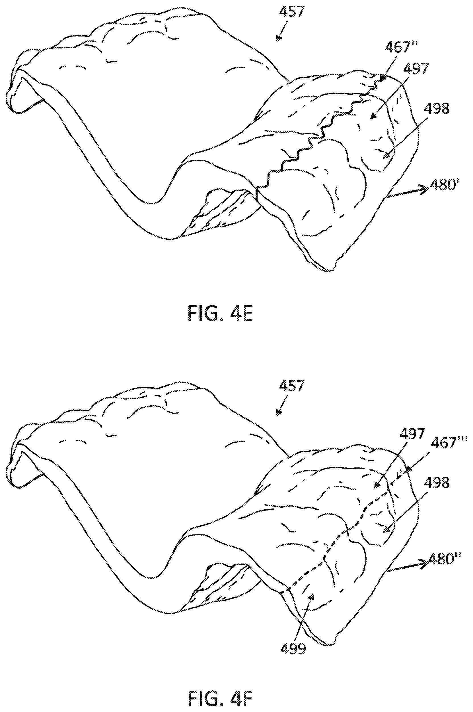 Patent US12097085 Figure 9 – Palatal expanders with breach regions