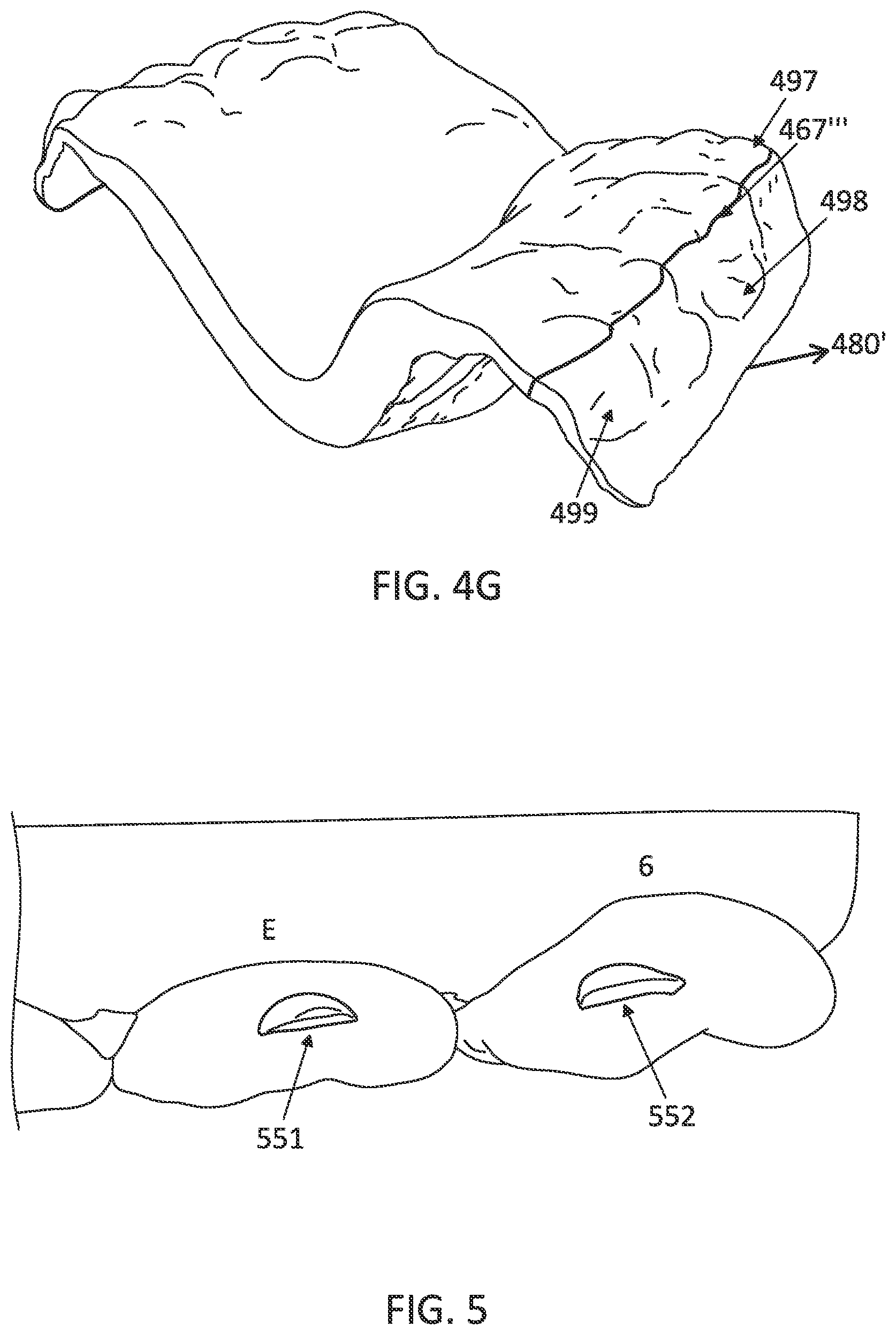 Patent US12097085 Figure 10 – Palatal expanders with breach regions