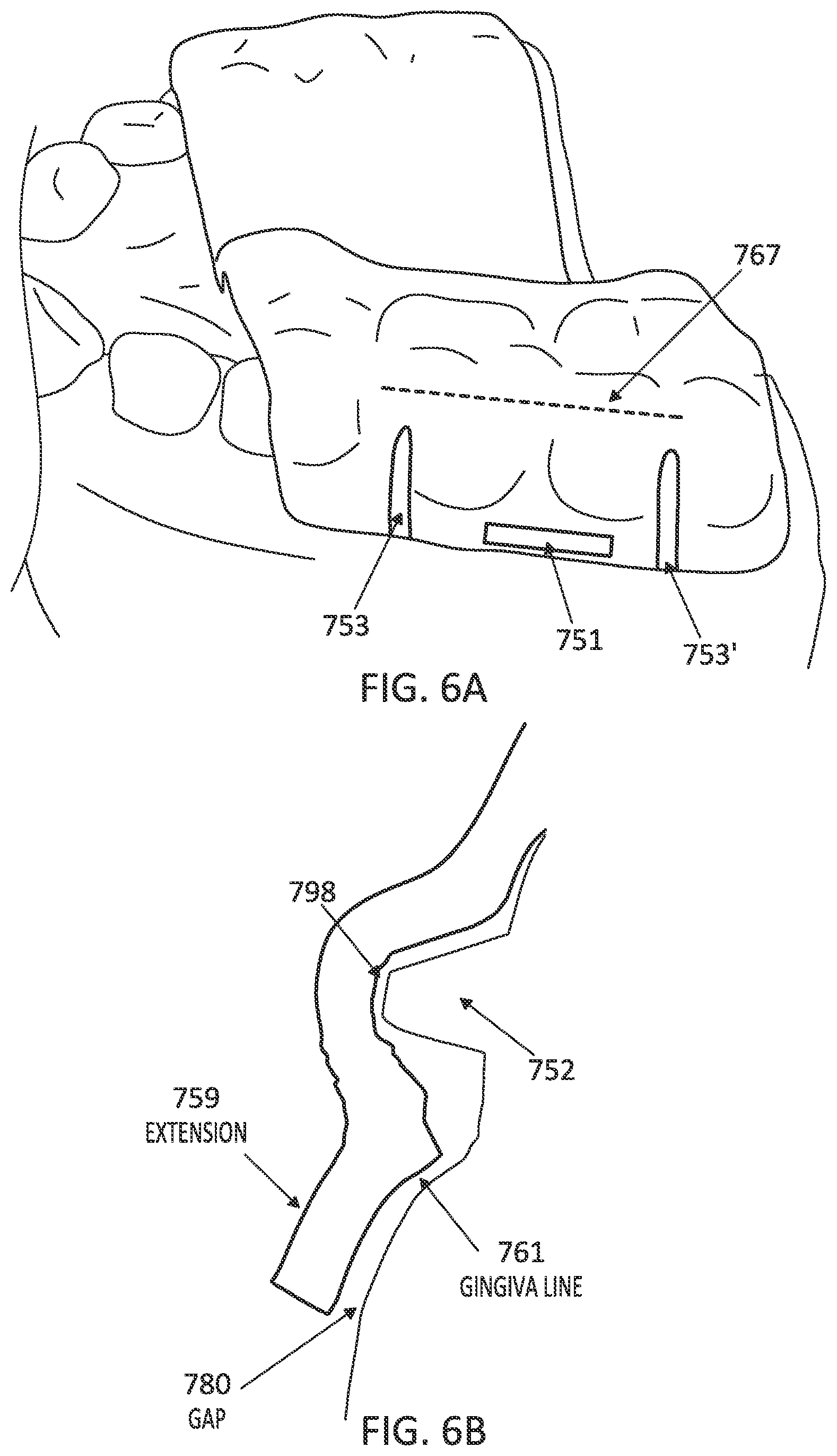 Patent US12097085 Figure 11 – Palatal expanders with breach regions