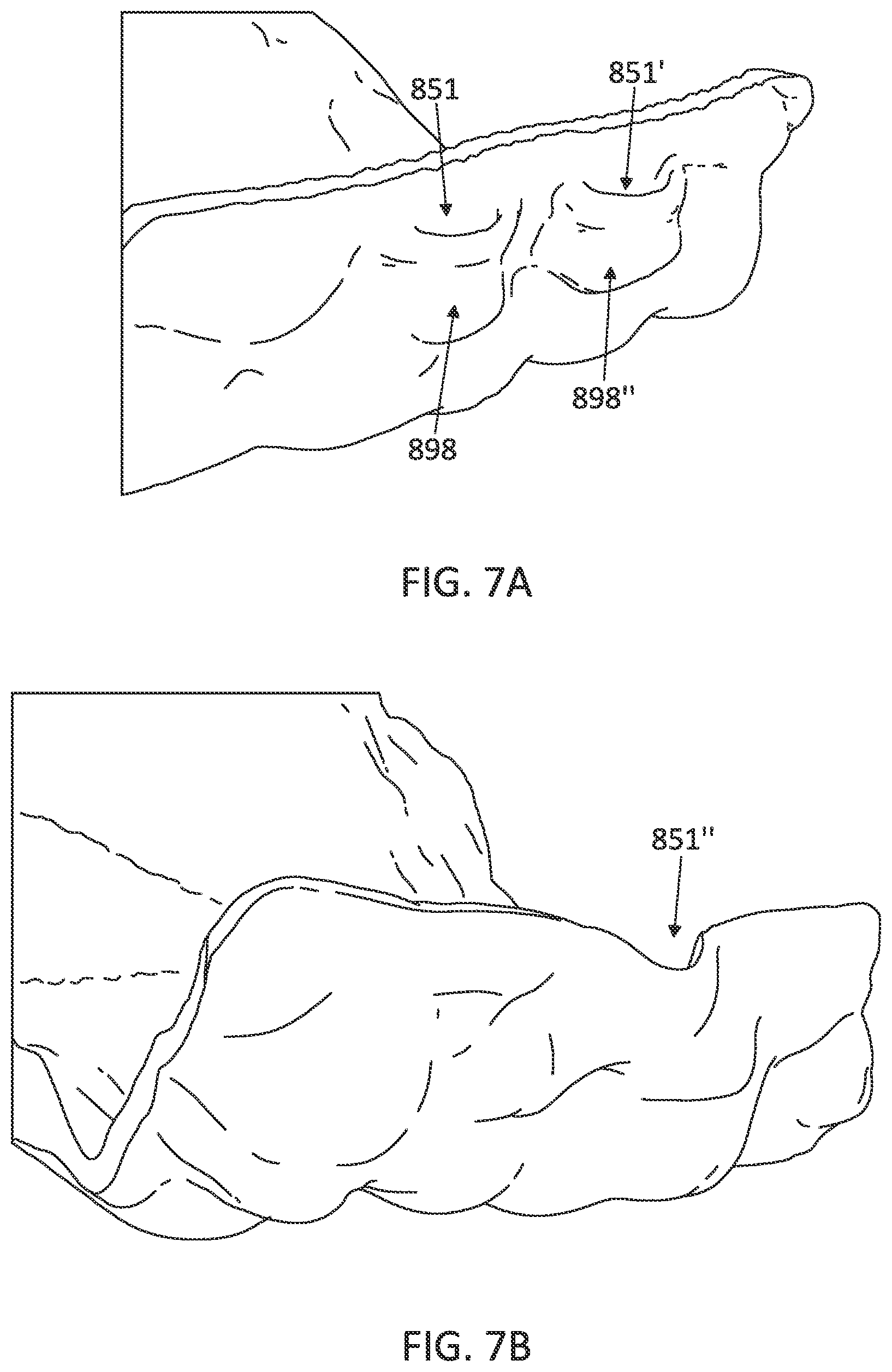 Patent US12097085 Figure 12 – Palatal expanders with breach regions