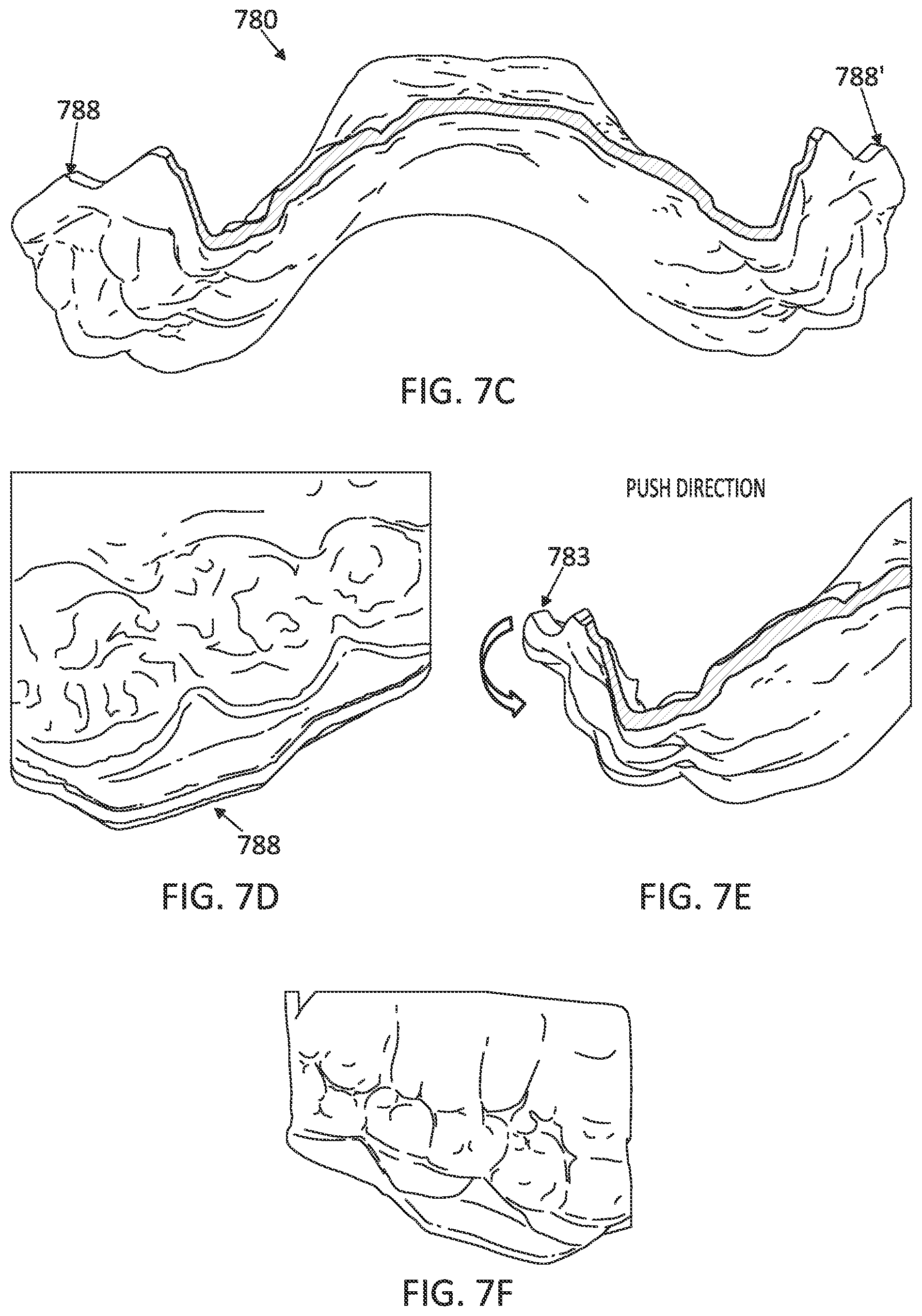 Patent US12097085 Figure 13 – Palatal expanders with breach regions
