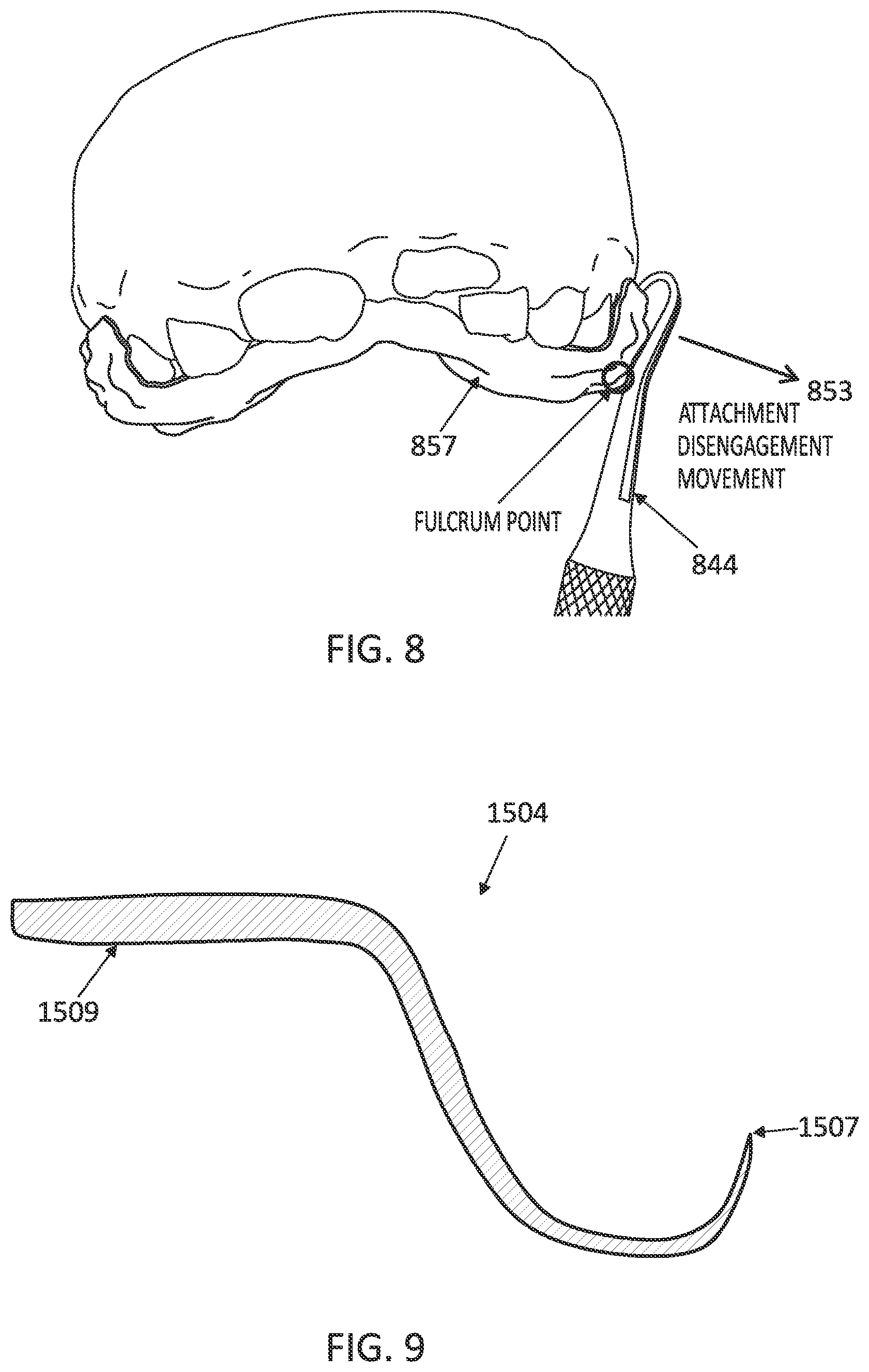 Patent US12097085 Figure 14 – Palatal expanders with breach regions