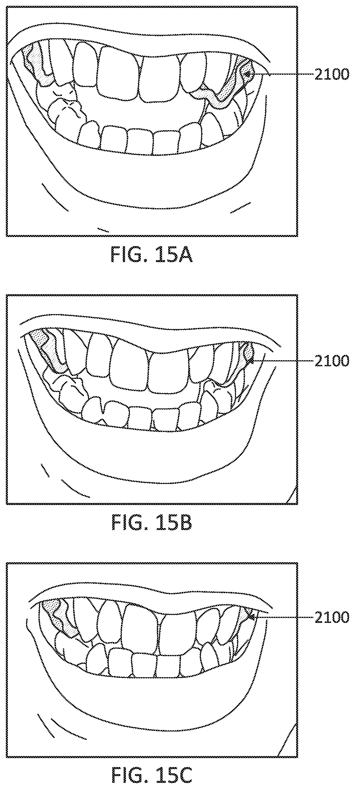 Patent US12097085 Figure 19 – Palatal expanders with breach regions