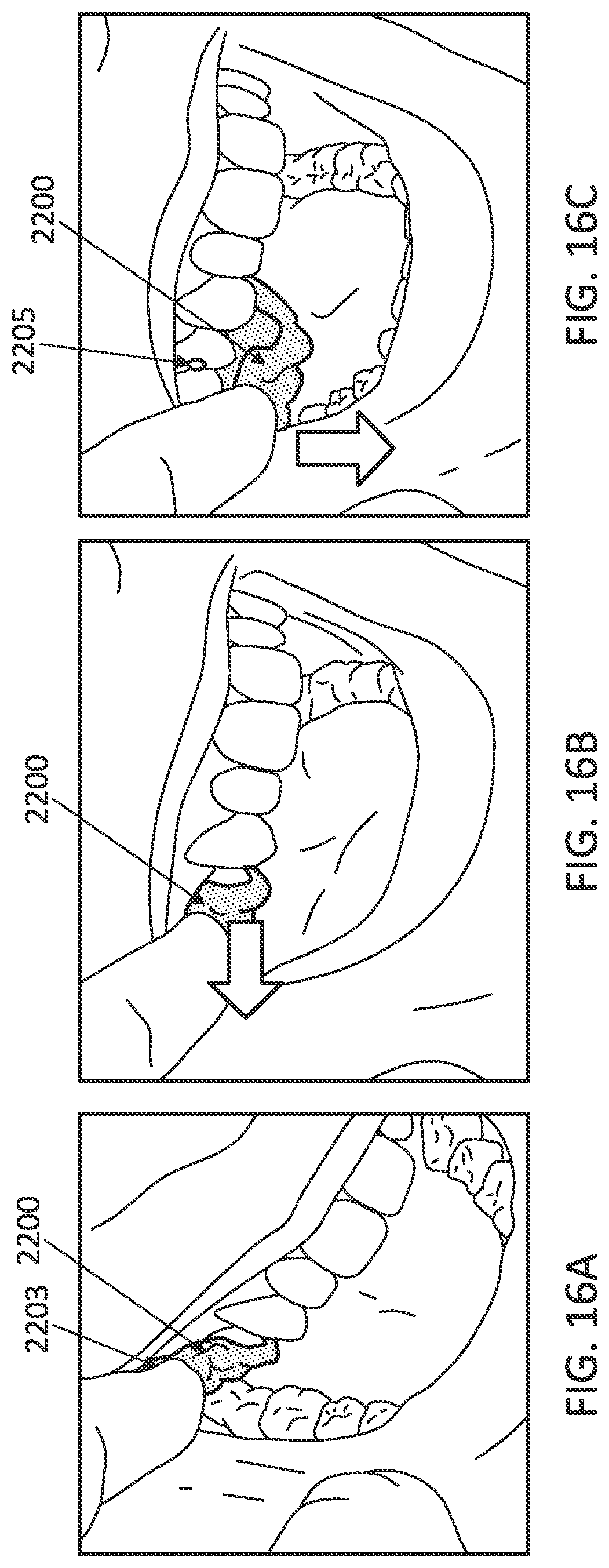 Patent US12097085 Figure 20 – Palatal expanders with breach regions