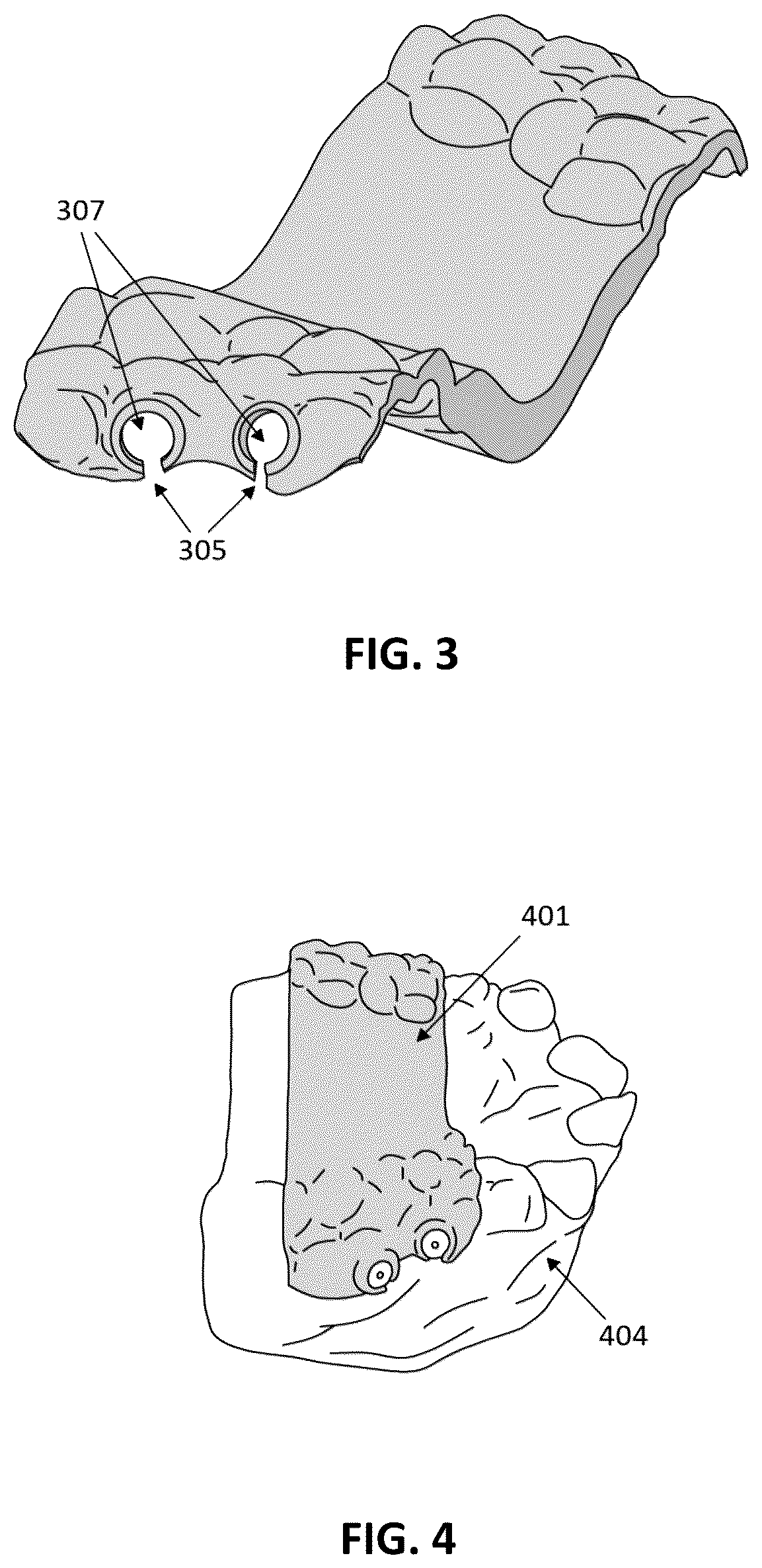 Patent US12097086 Figure 2 – Palatal expanders and methods of designing palatal expanders