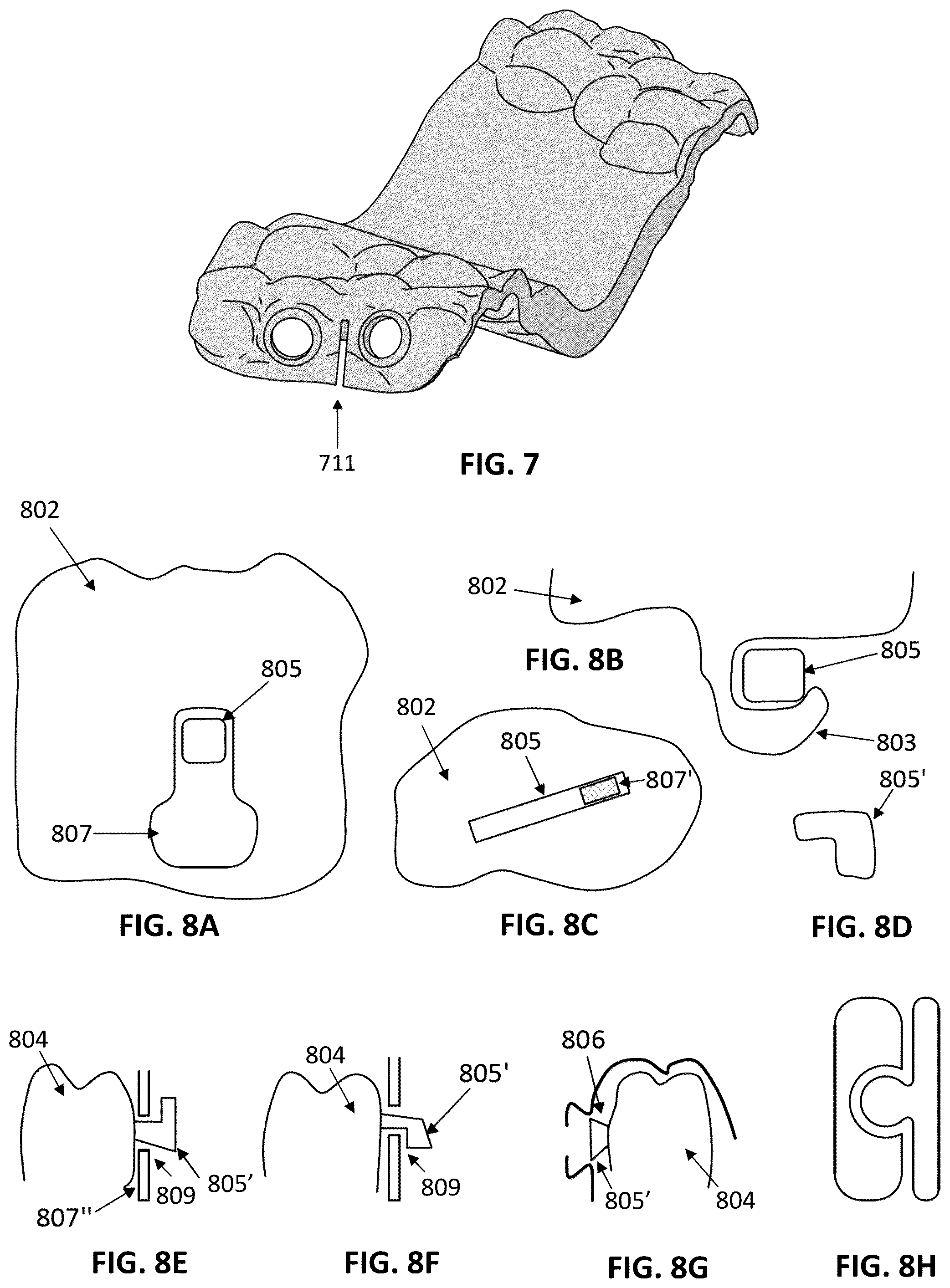 Patent US12097086 Figure 4 – Palatal expanders and methods of designing palatal expanders