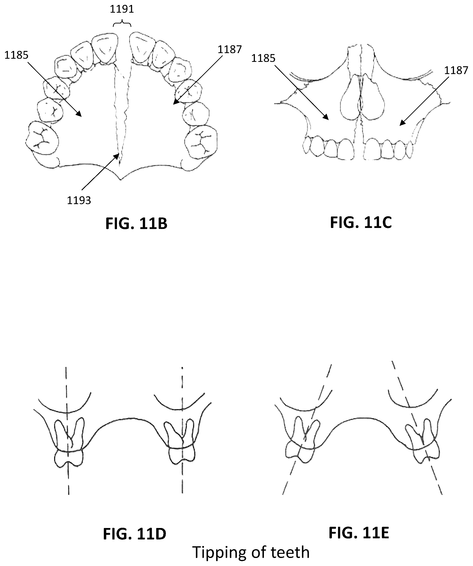 Patent US12097086 Figure 8 – Palatal expanders and methods of designing palatal expanders