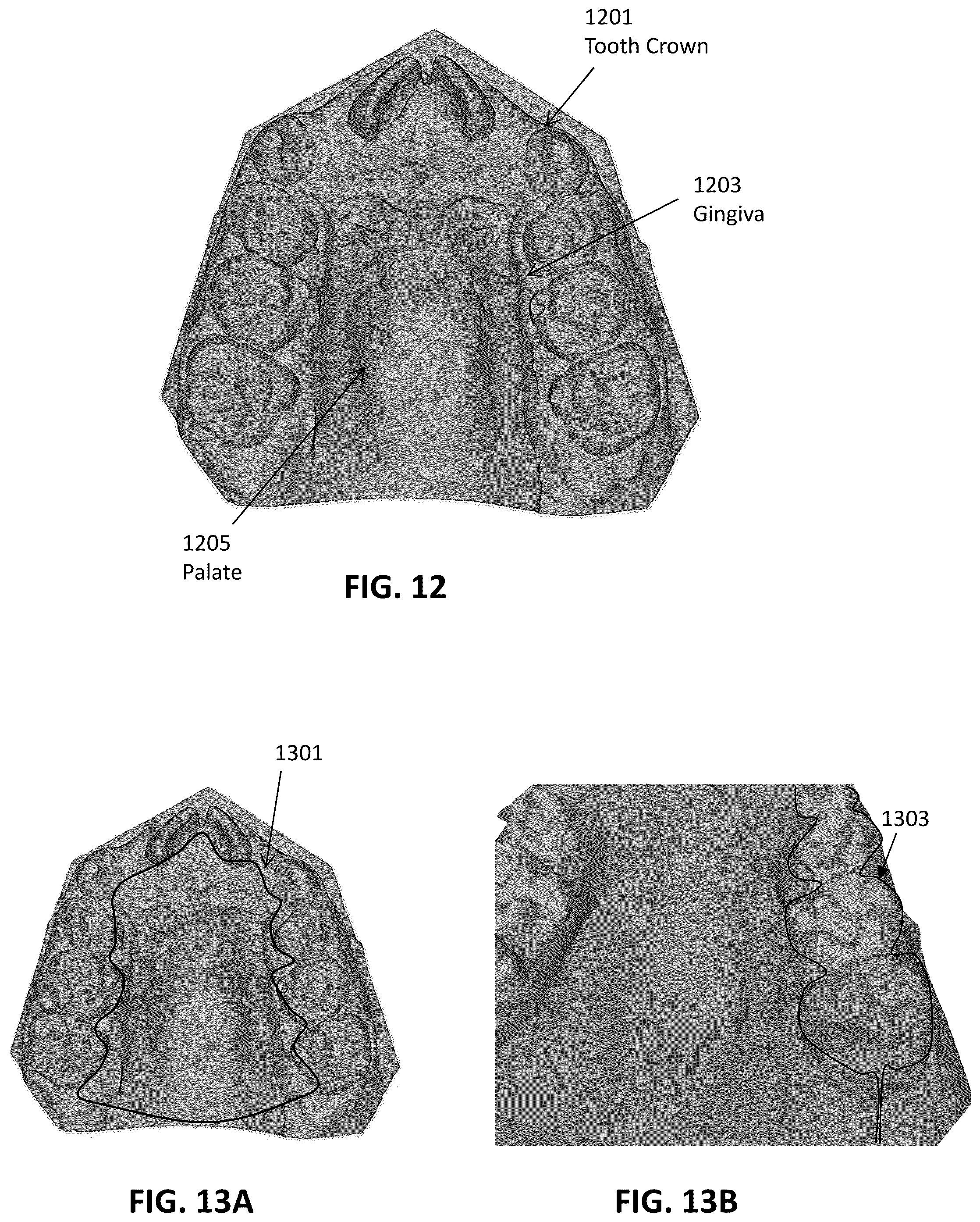 Patent US12097086 Figure 10 – Palatal expanders and methods of designing palatal expanders