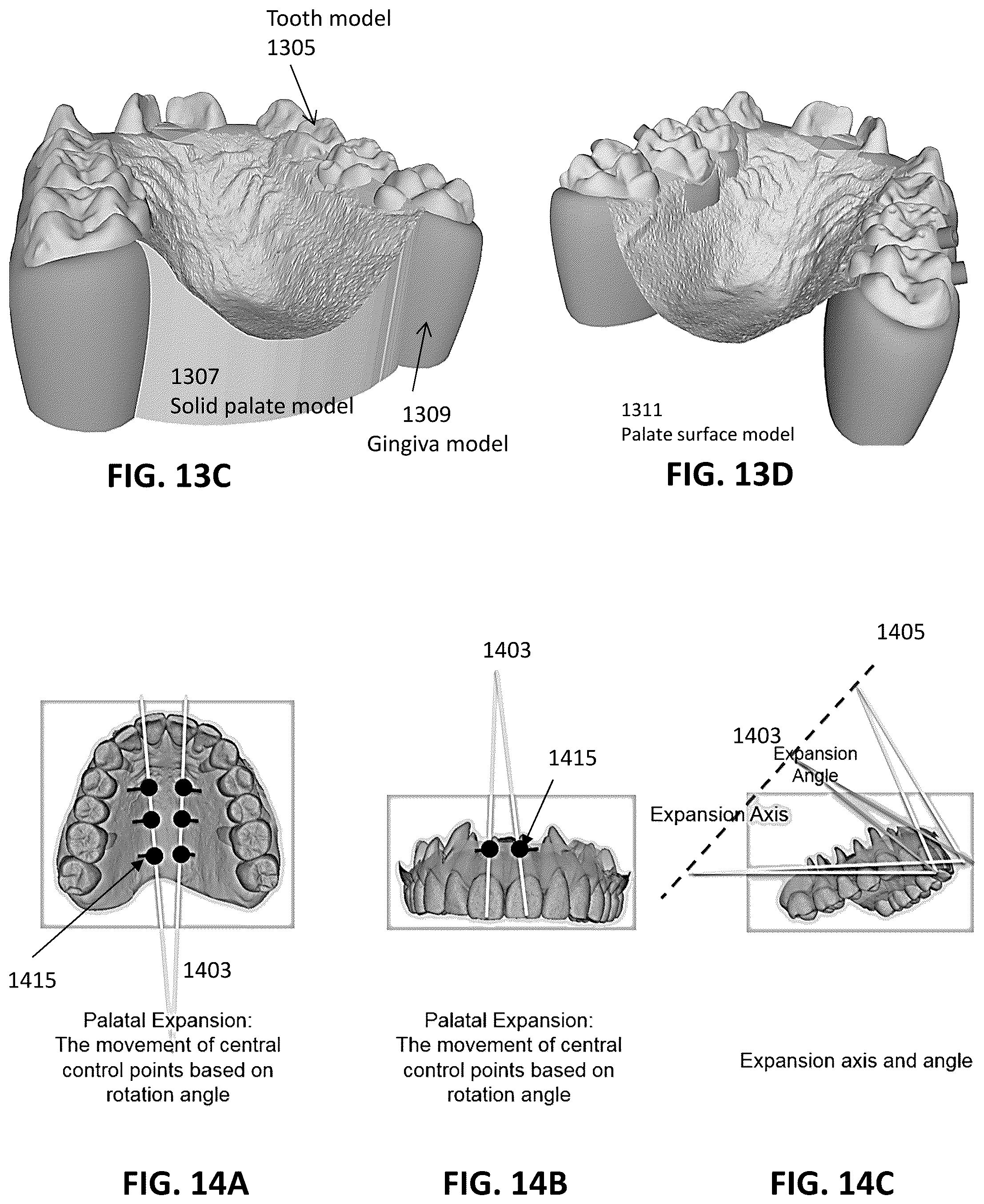Patent US12097086 Figure 11 – Palatal expanders and methods of designing palatal expanders