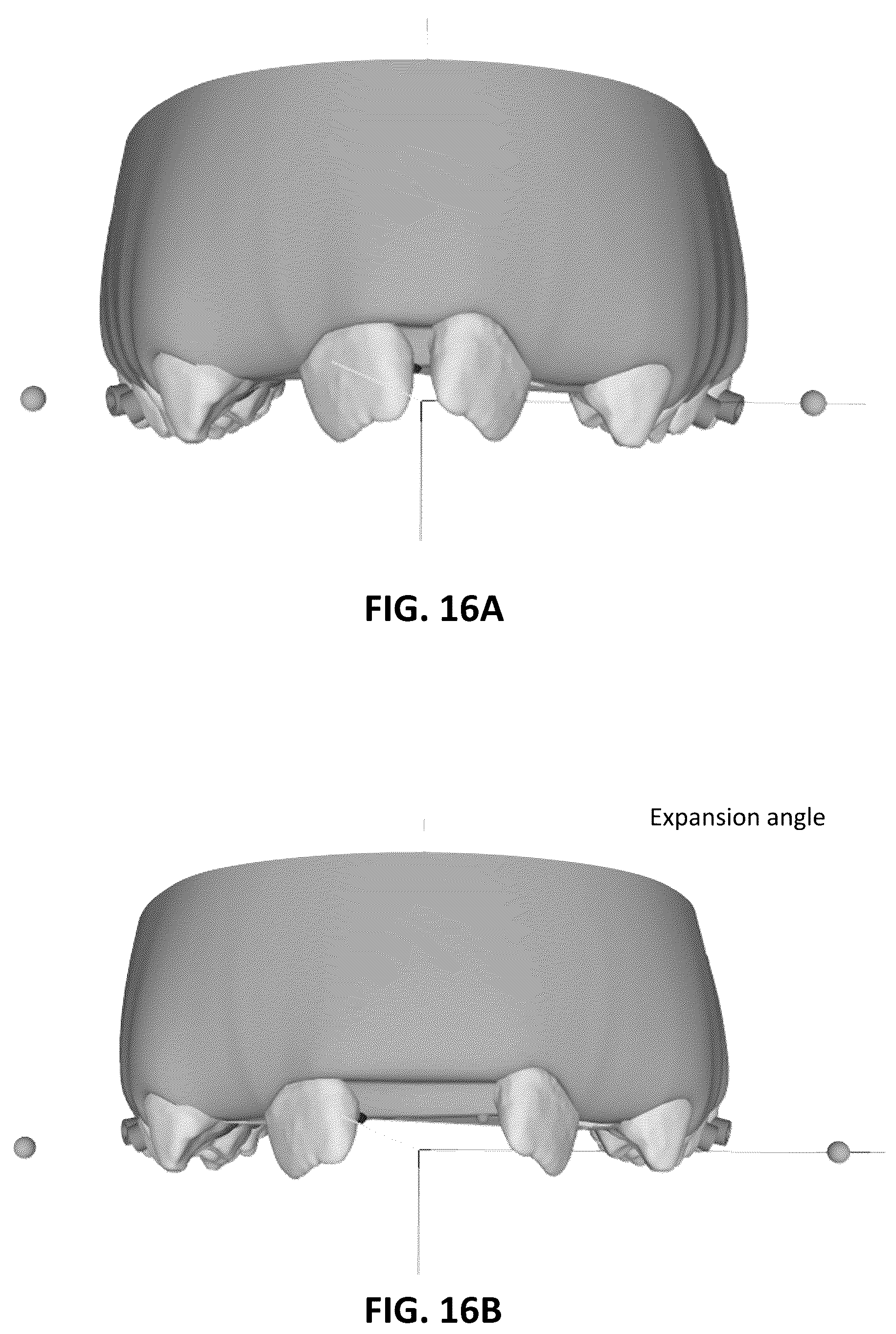 Patent US12097086 Figure 13 – Palatal expanders and methods of designing palatal expanders