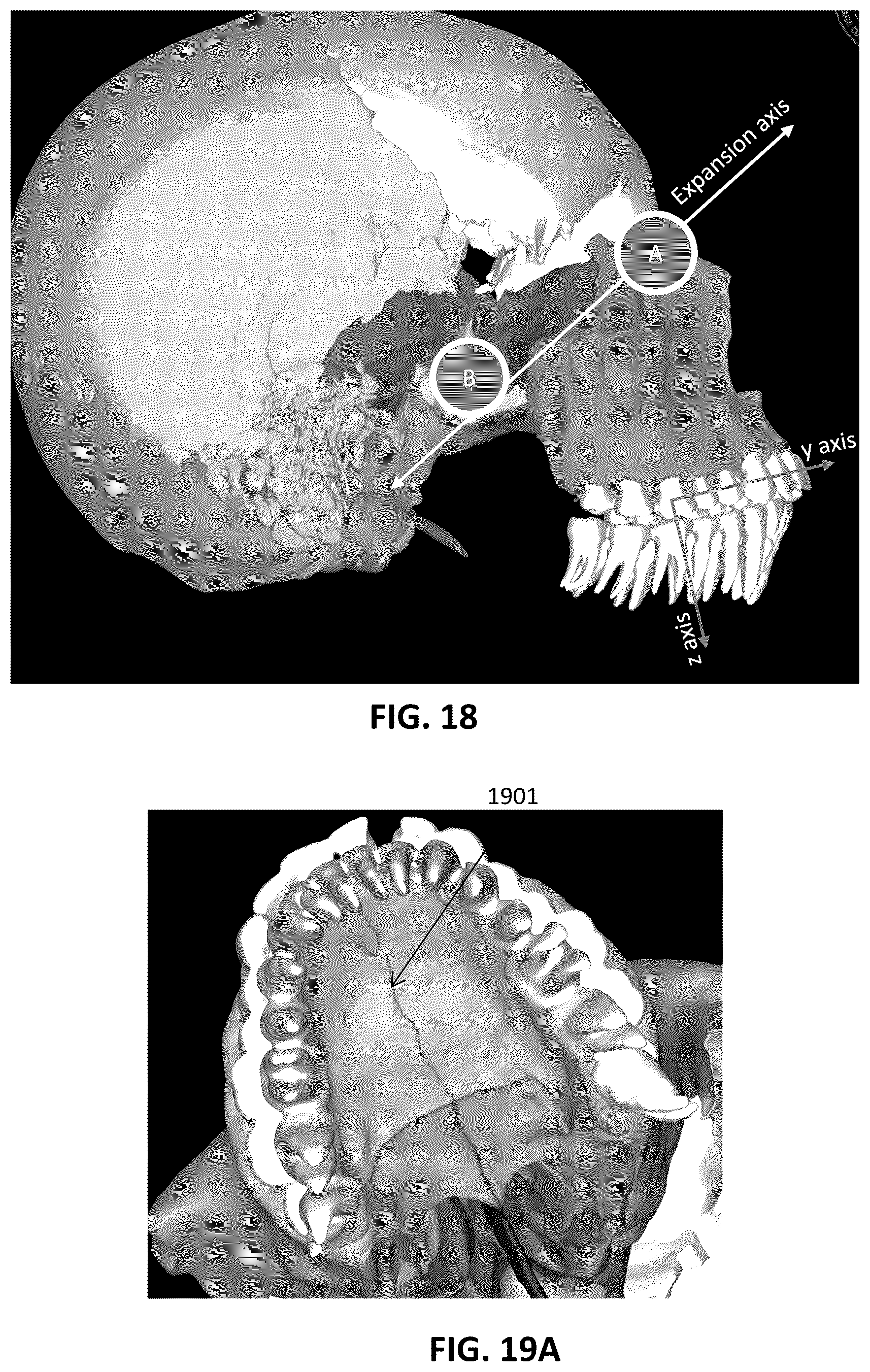 Patent US12097086 Figure 15 – Palatal expanders and methods of designing palatal expanders