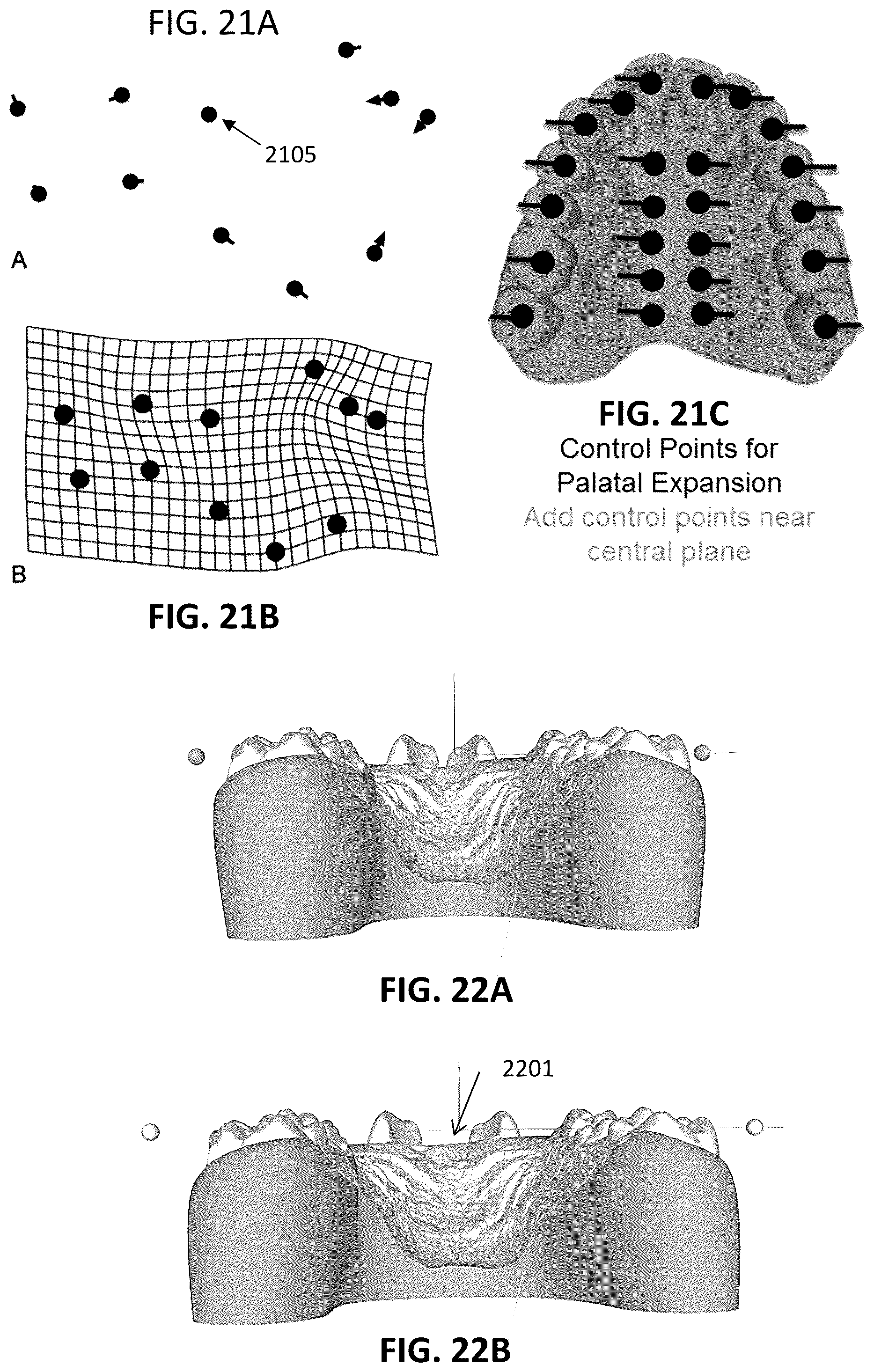 Patent US12097086 Figure 17 – Palatal expanders and methods of designing palatal expanders