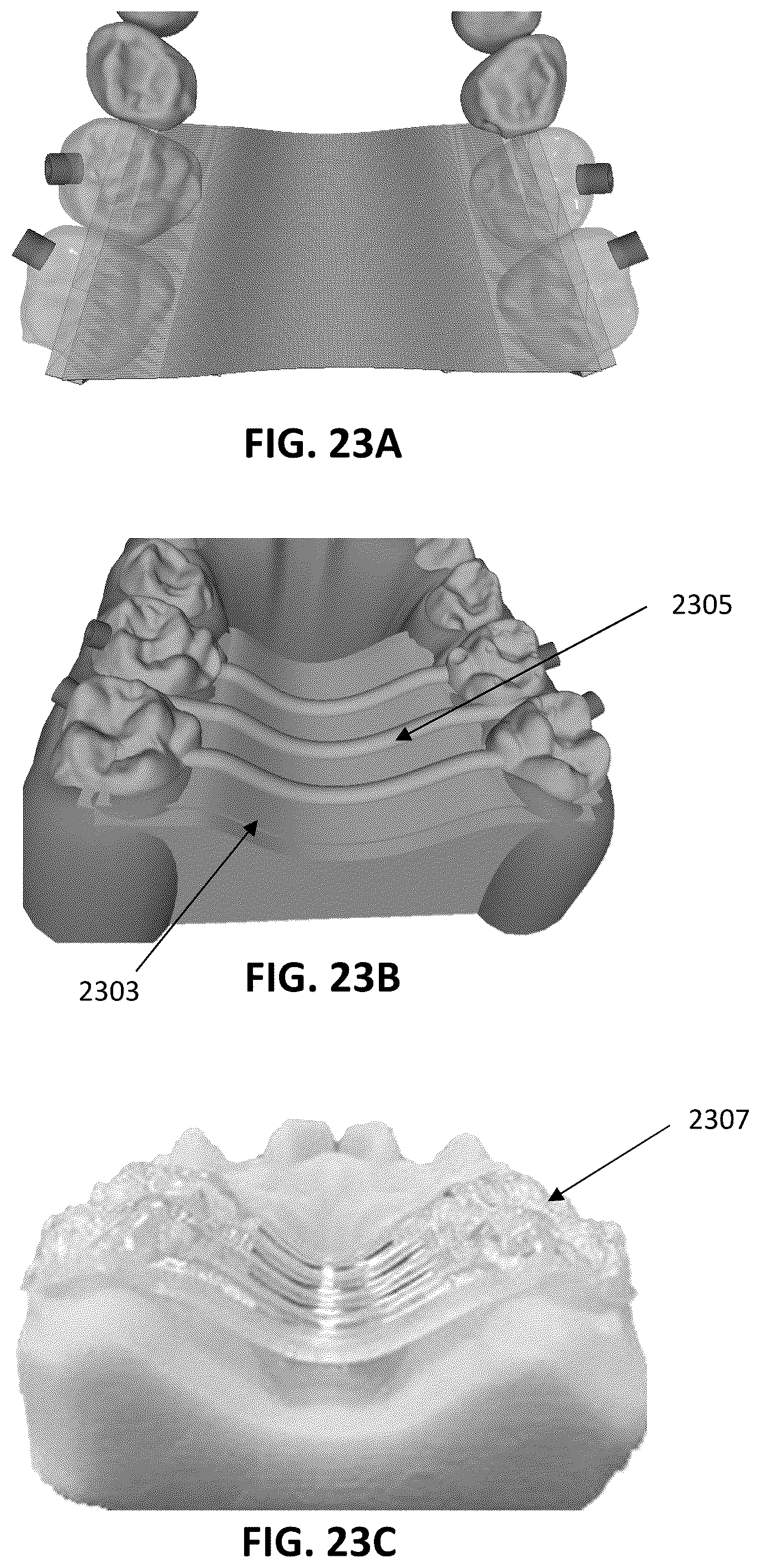 Patent US12097086 Figure 18 – Palatal expanders and methods of designing palatal expanders
