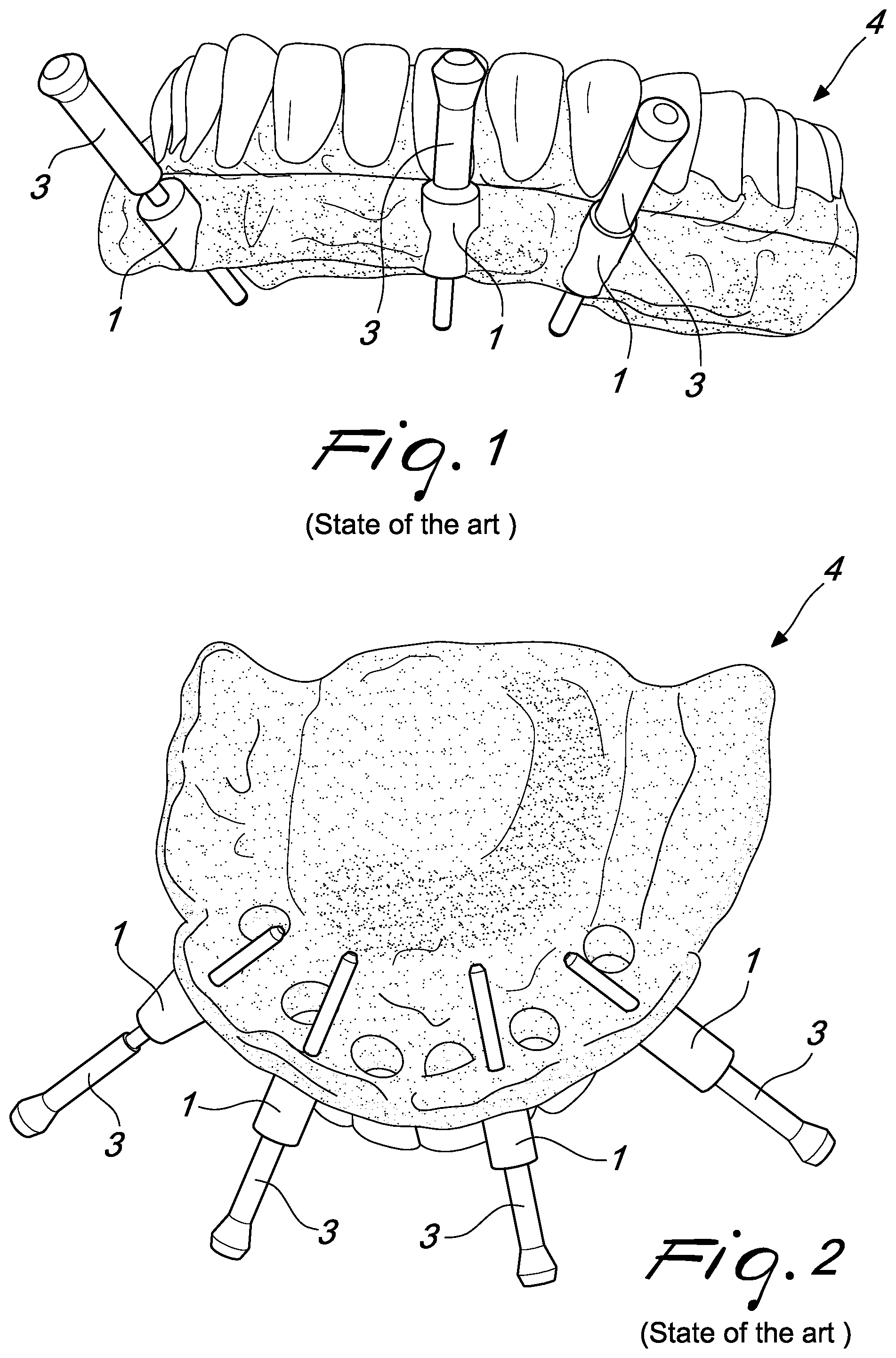 Patent US12097088 Figure 1 – Fixing pin support for dental prostheses and method of the manufacturing thereof