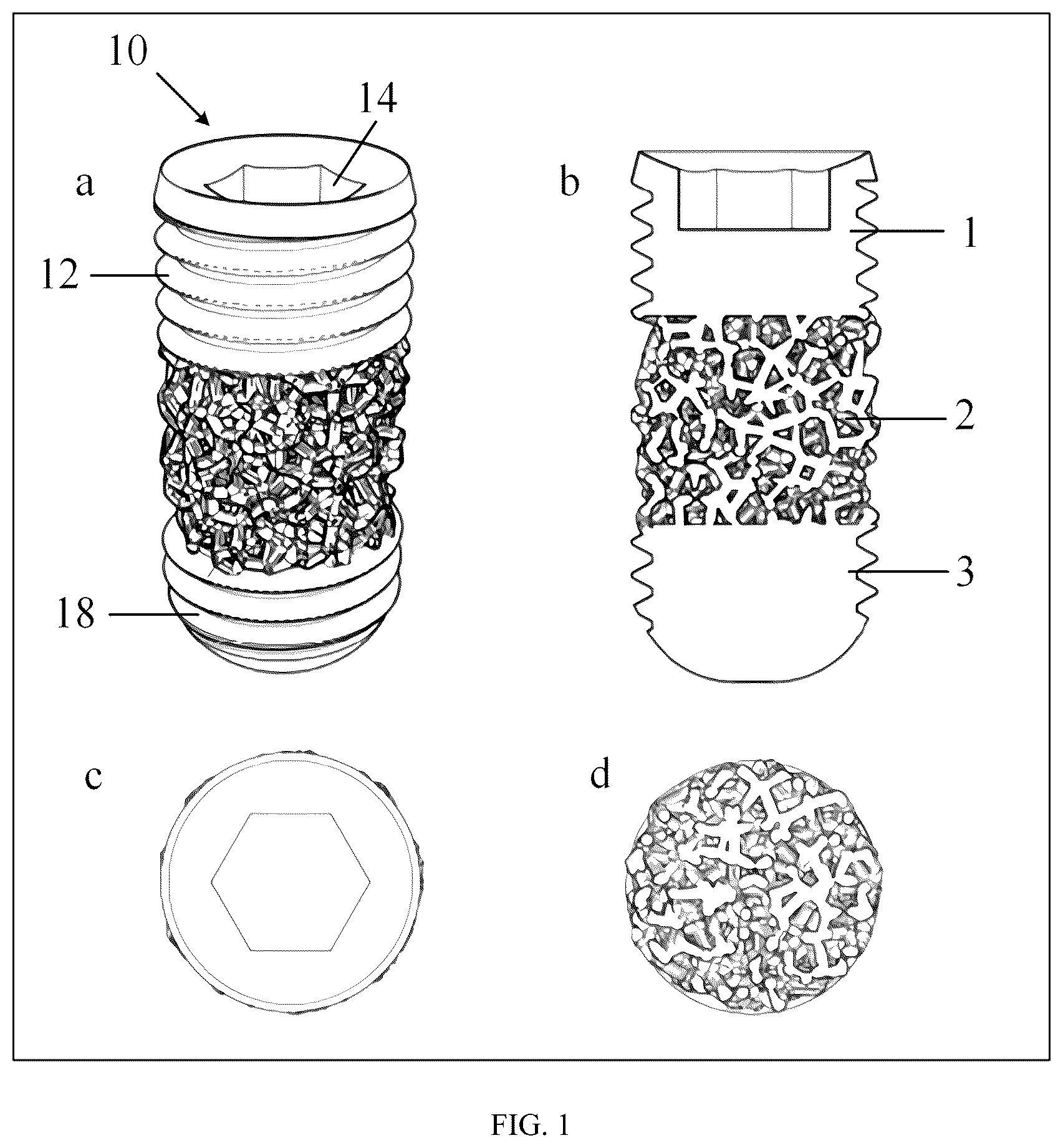 Patent US12097089 Figure 1 – Trabecular porous tantalum dental implant and preparation method thereof