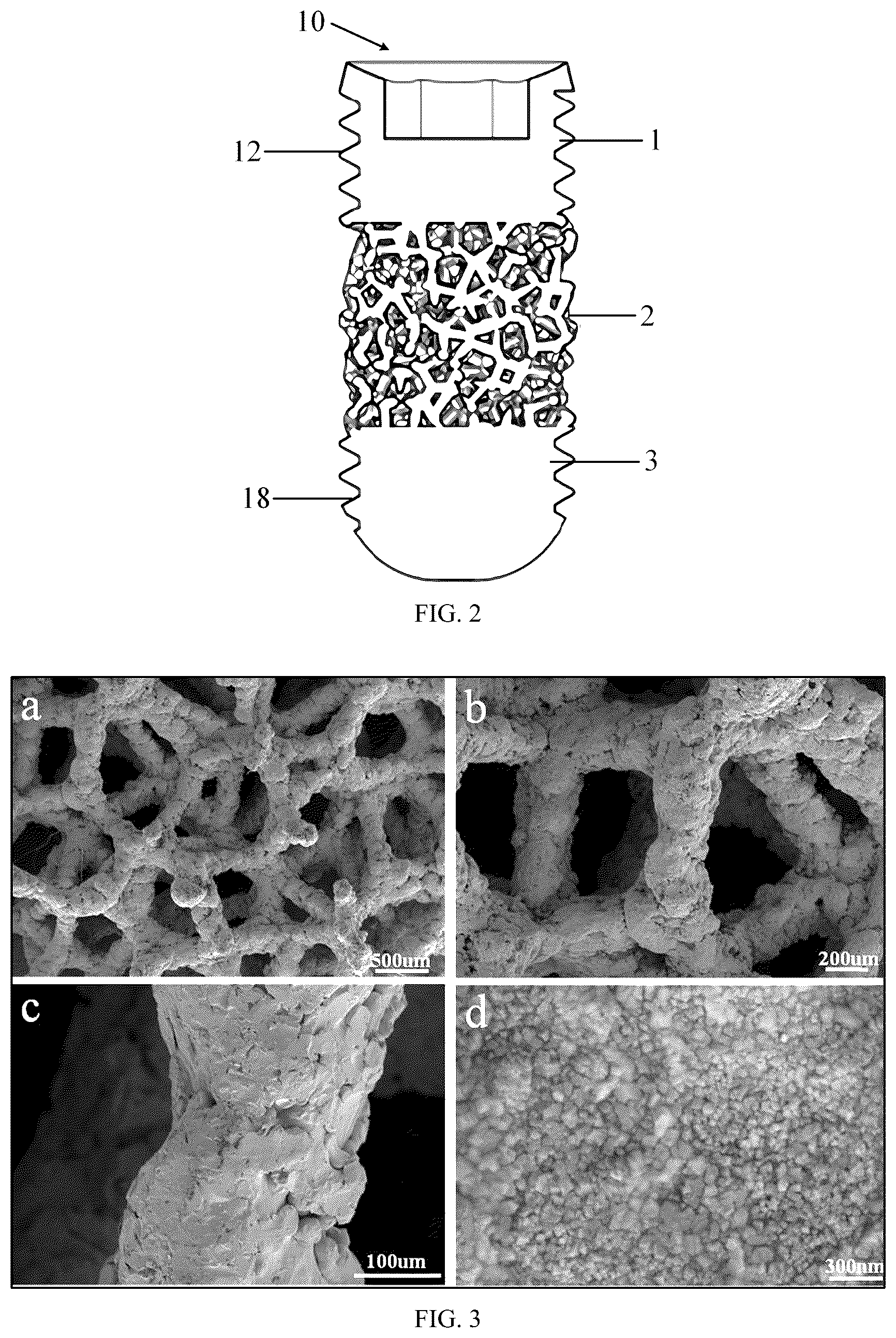 Patent US12097089 Figure 2 – Trabecular porous tantalum dental implant and preparation method thereof