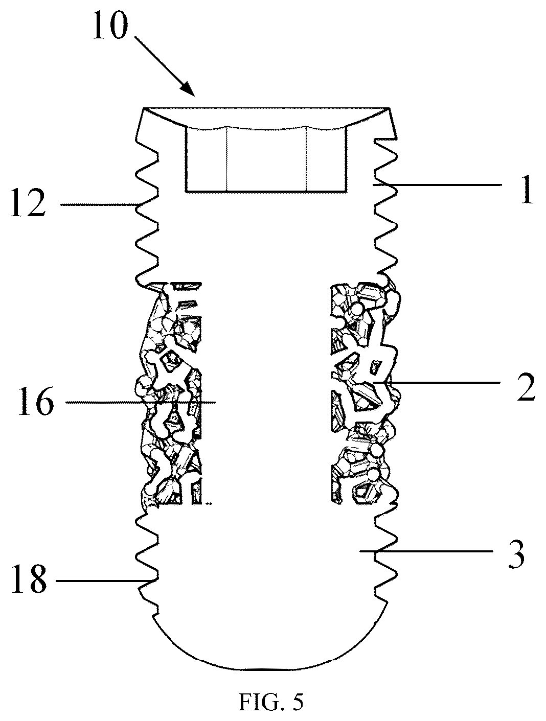 Patent US12097089 Figure 4 – Trabecular porous tantalum dental implant and preparation method thereof