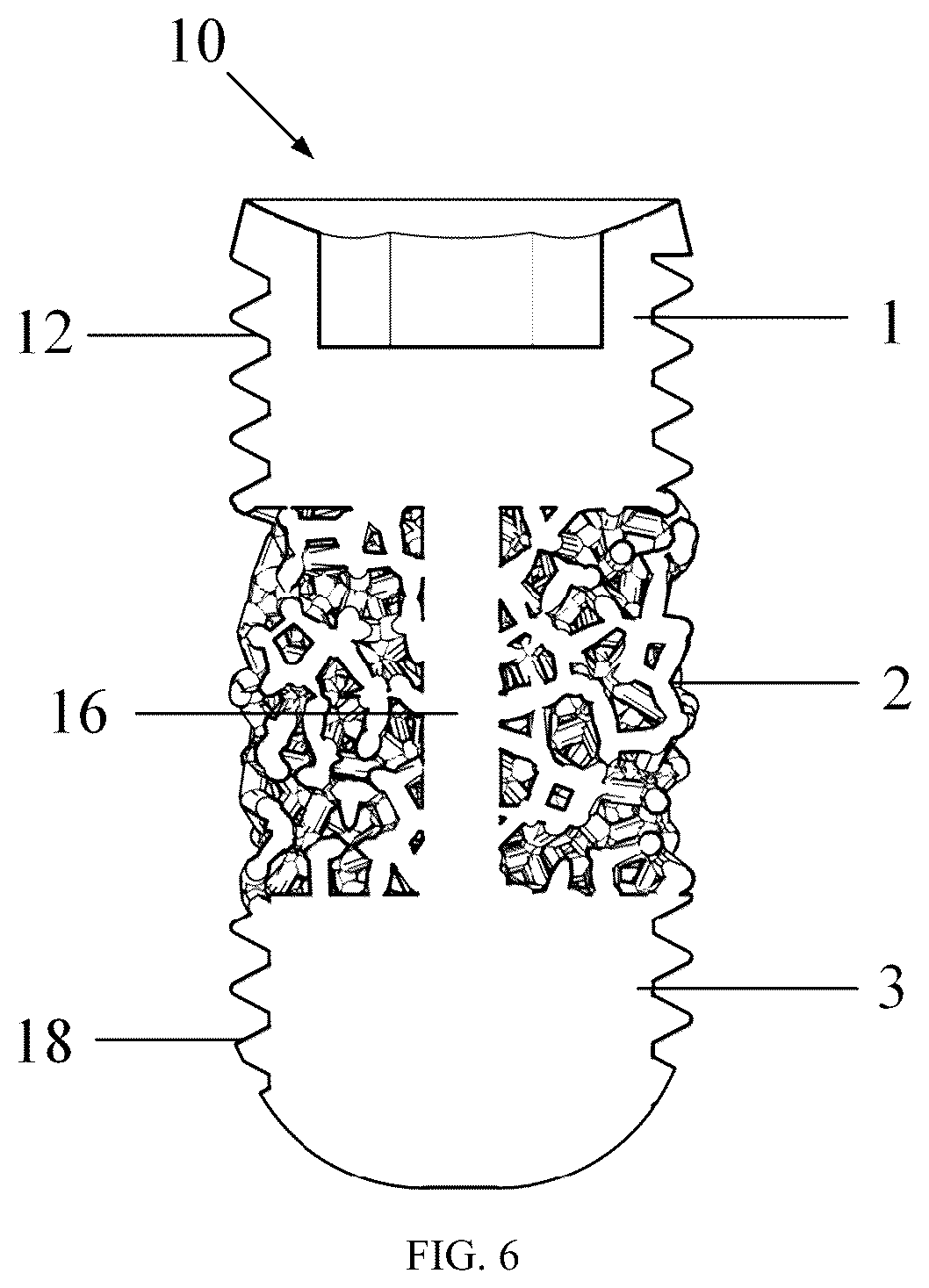 Patent US12097089 Figure 5 – Trabecular porous tantalum dental implant and preparation method thereof