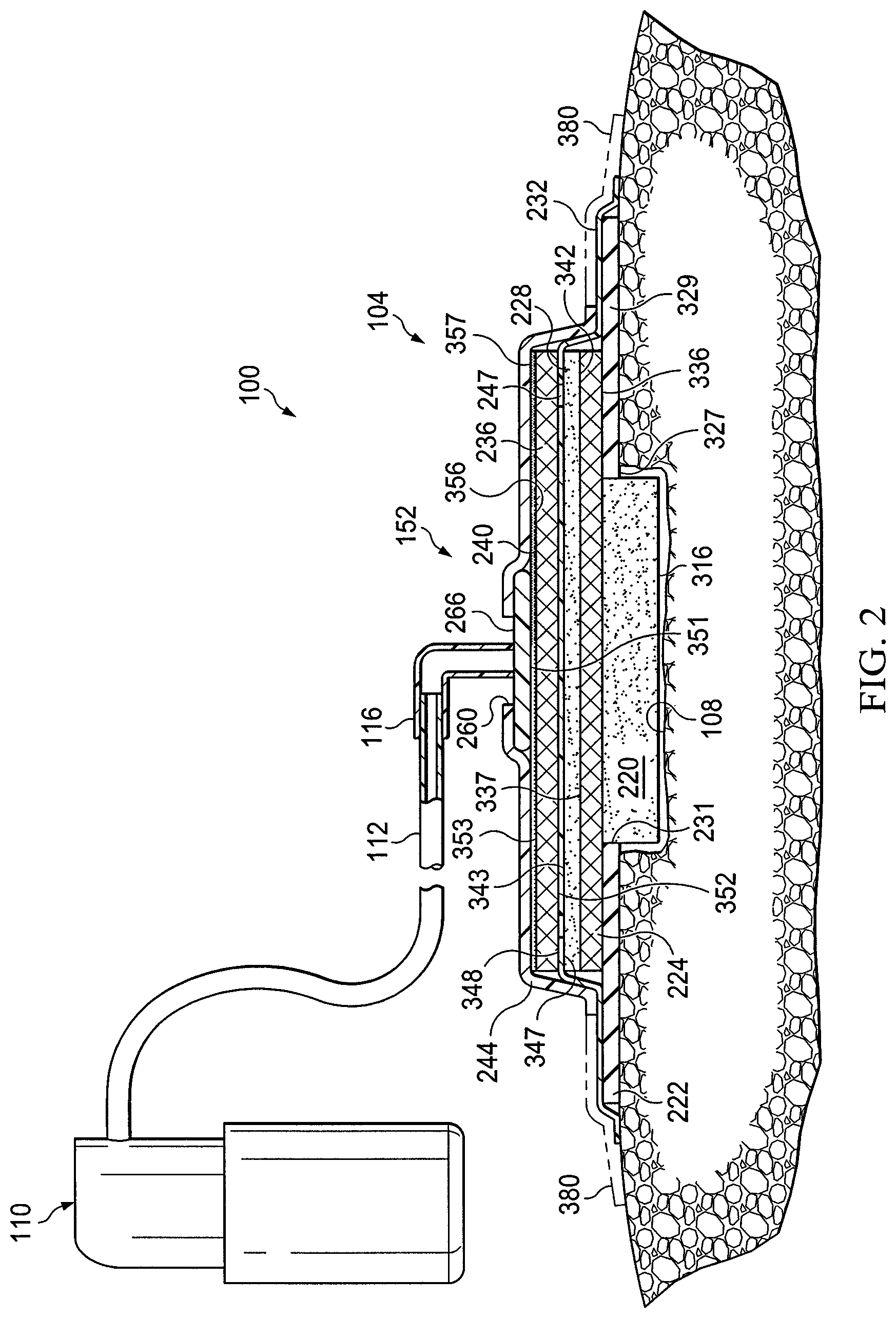 Patent US12097094 Figure 2 – Dressing and method for applying reduced pressure to and collecting and storing fluid from a tissue site
