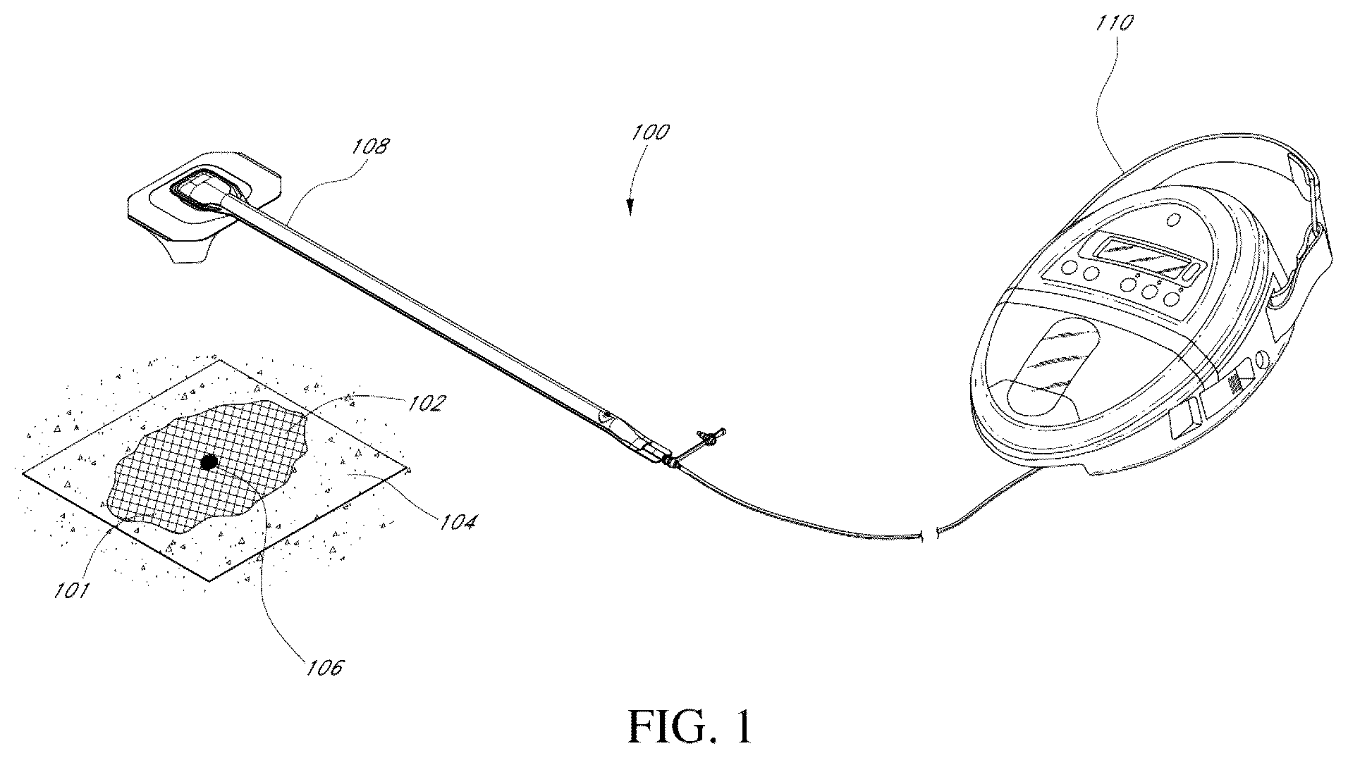 Patent US12097096 Figure 1 – Customizable wound closure device and method of use