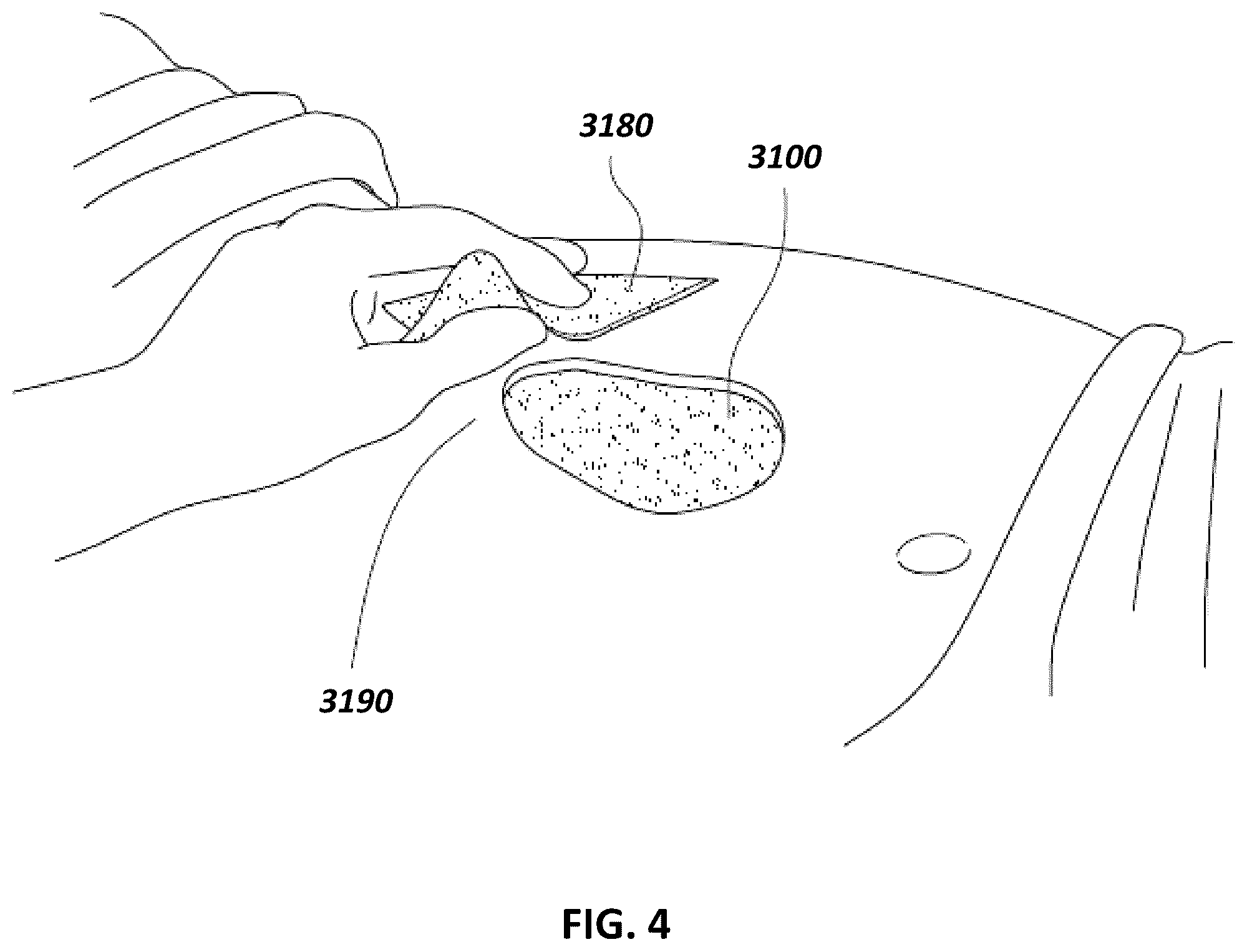 Patent US12097096 Figure 4 – Customizable wound closure device and method of use