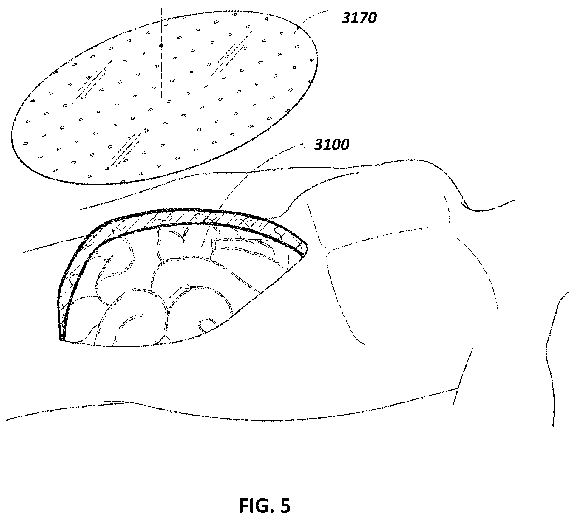 Patent US12097096 Figure 5 – Customizable wound closure device and method of use